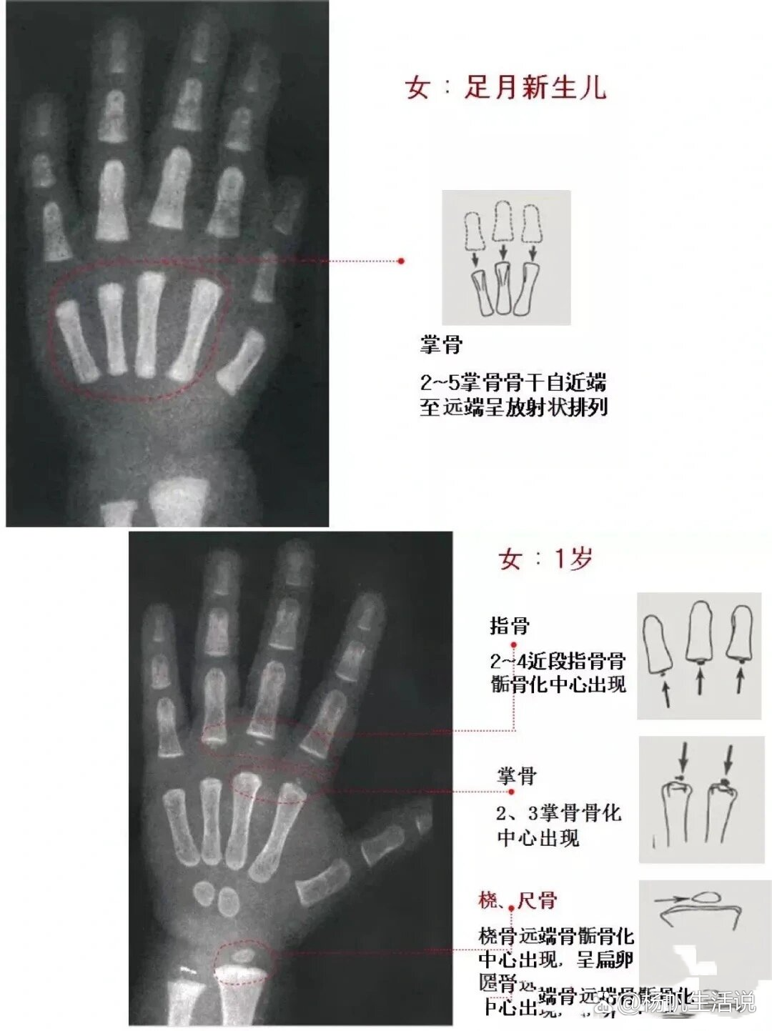 女童骨龄图谱