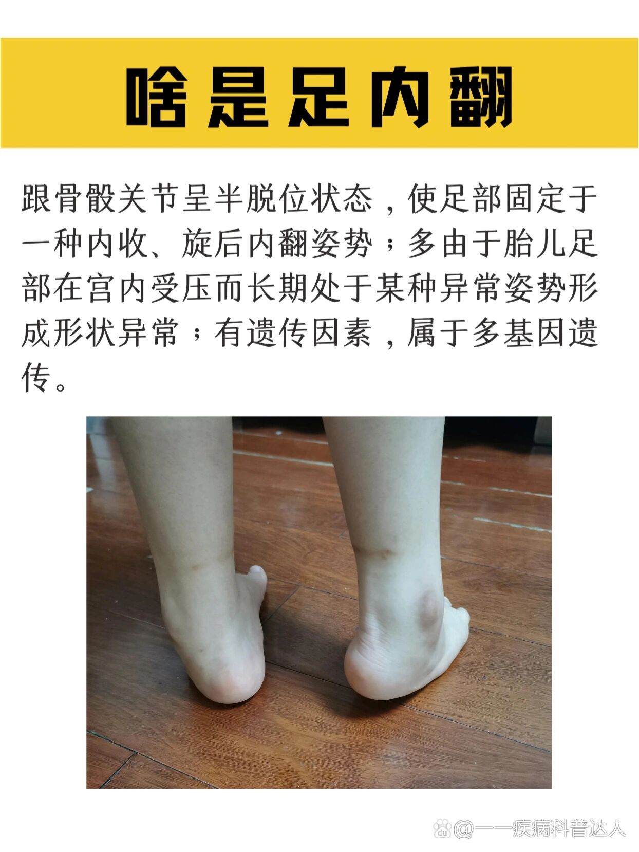 1分钟辨别你是足外翻还是足内翻!