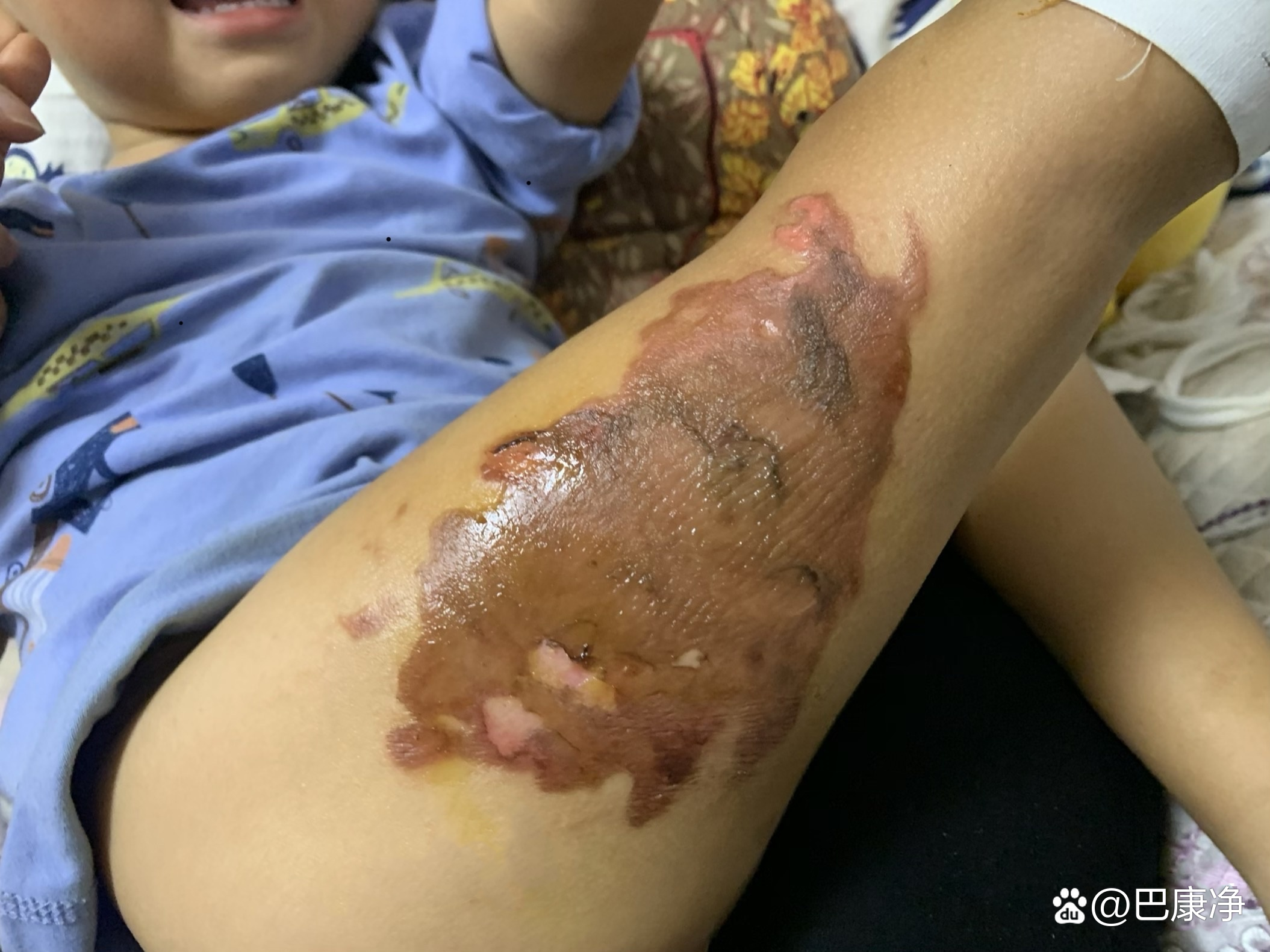 宝宝不小心打翻泡面大面积烫伤,伤口让人心疼.