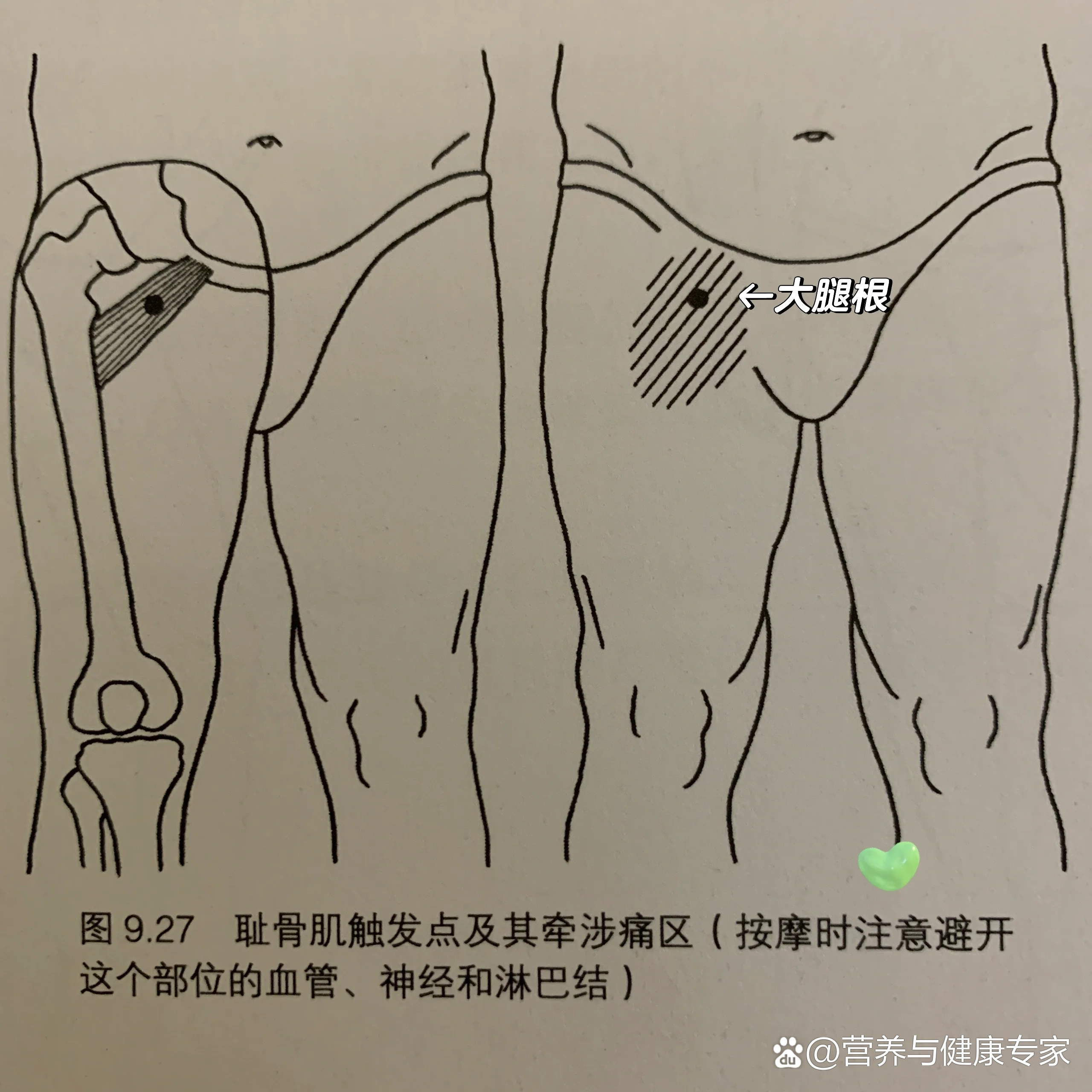 腹股沟长斑图片