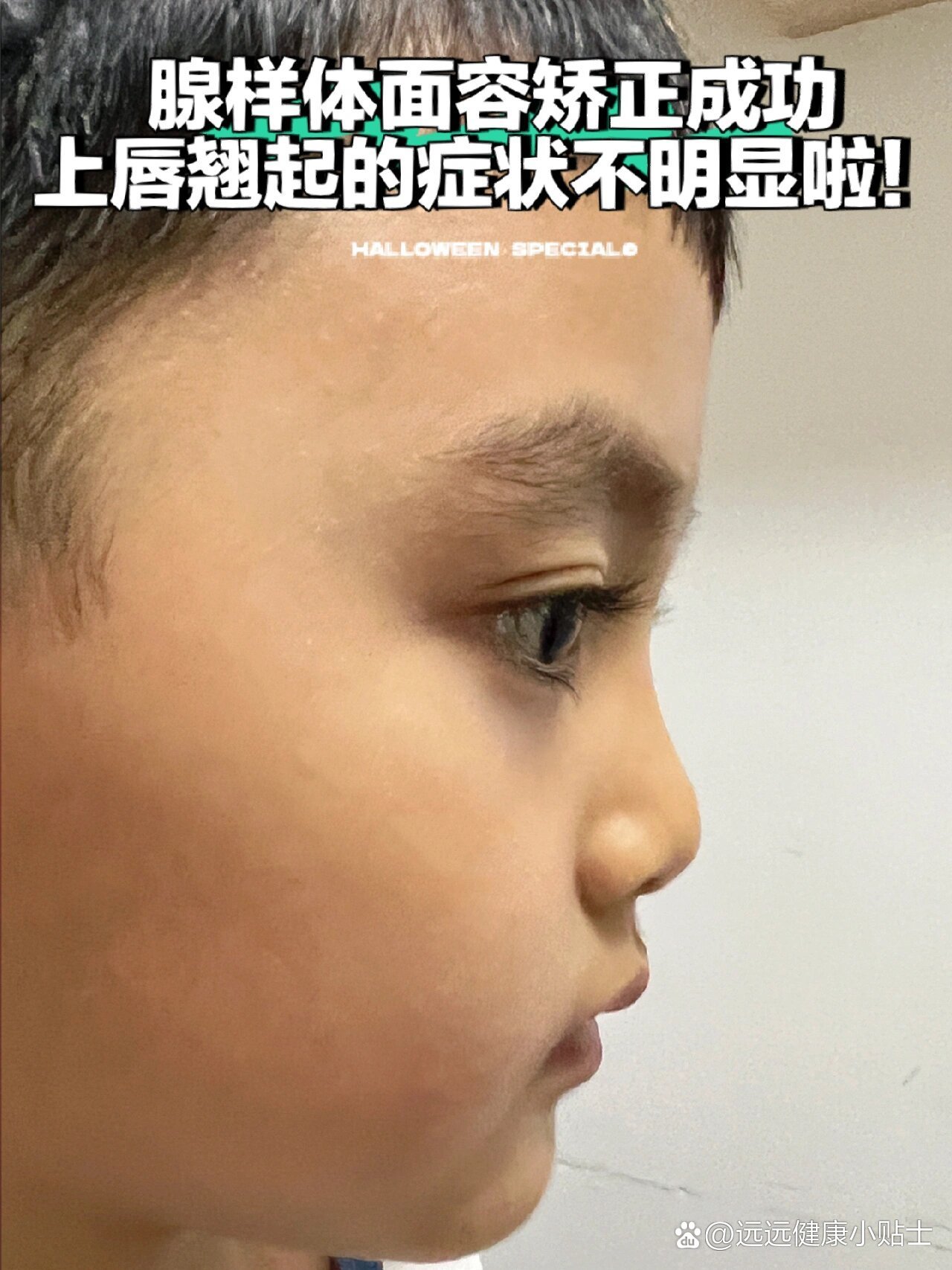 腺样体面容矫正成功后分享一下现在的侧脸