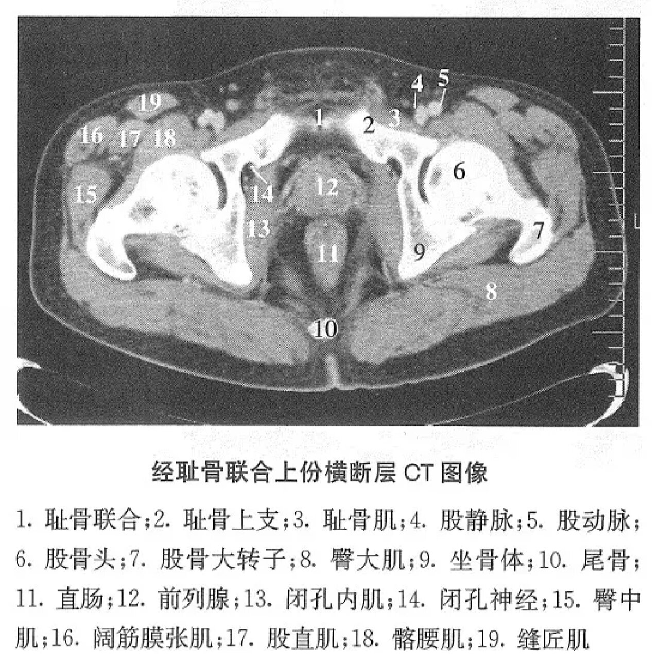 耻骨上支骨折图片