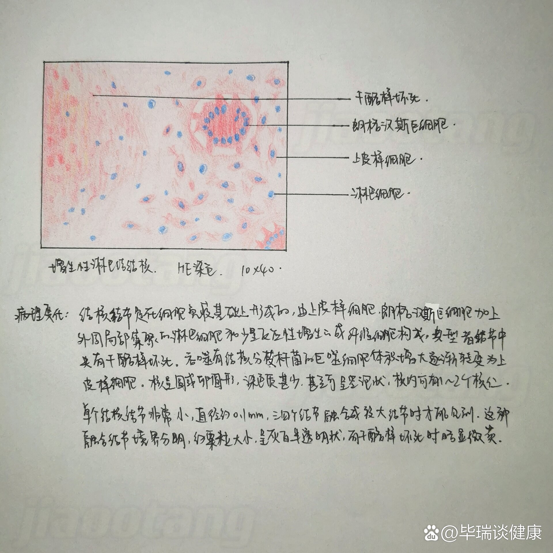 结核结节病理手绘图图片