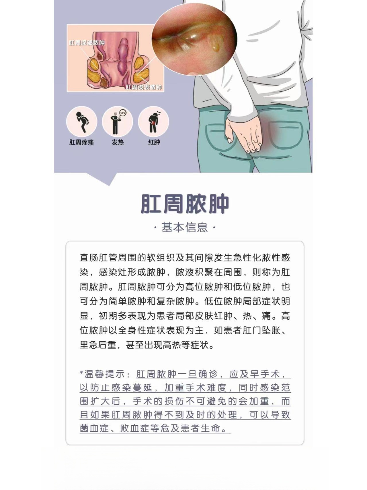 肛周脓肿只有硬块没脓图片