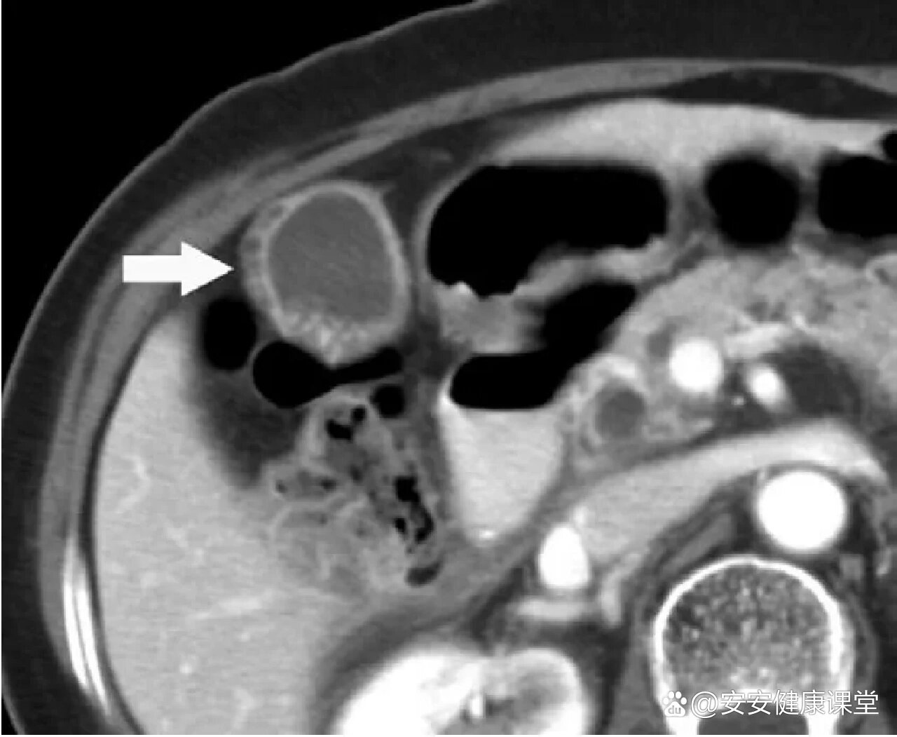 胆囊区解剖&胆囊腺肌症,建议收藏❤️