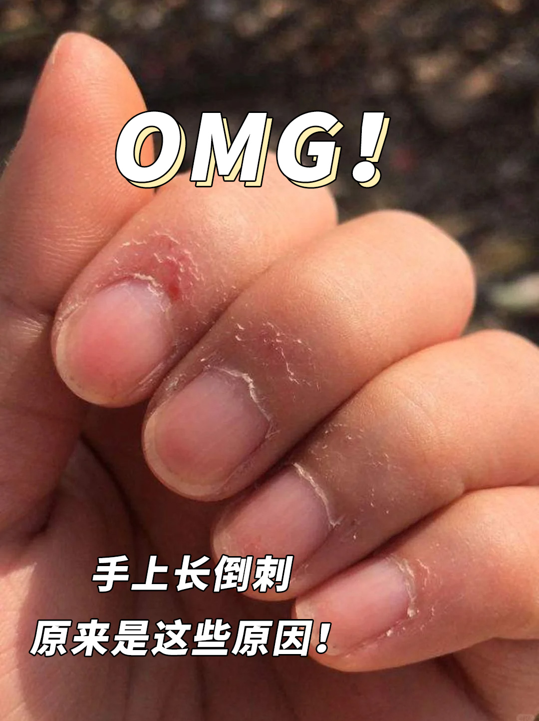 omg!手上长倒刺原来是这些原因!