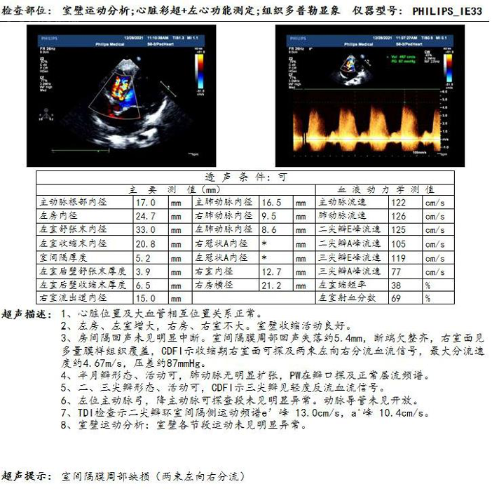右腋下小切口治疗室间隔缺损