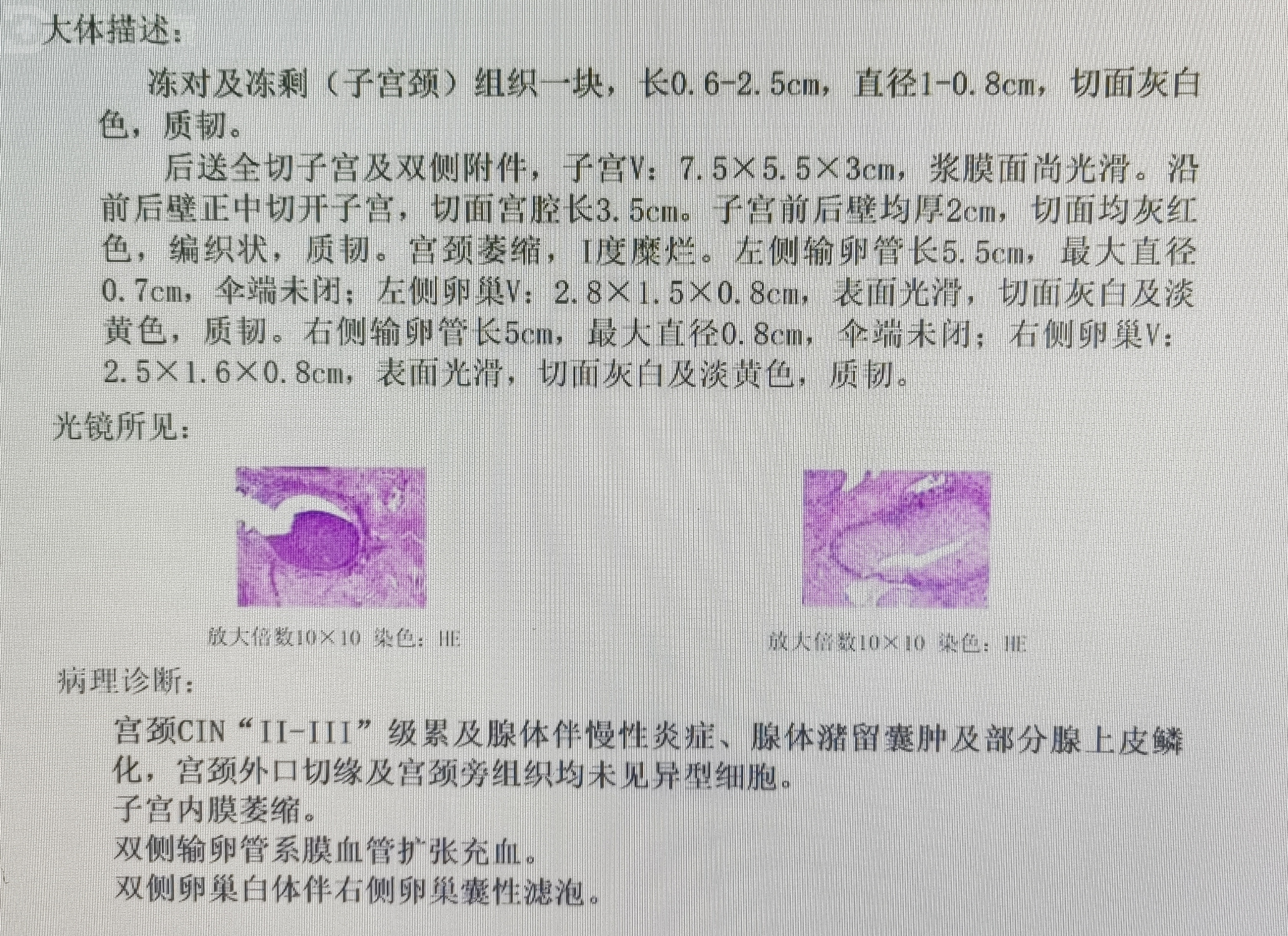 遂行阴道镜检查,取宫颈活检,病理提示:(宫颈)高级