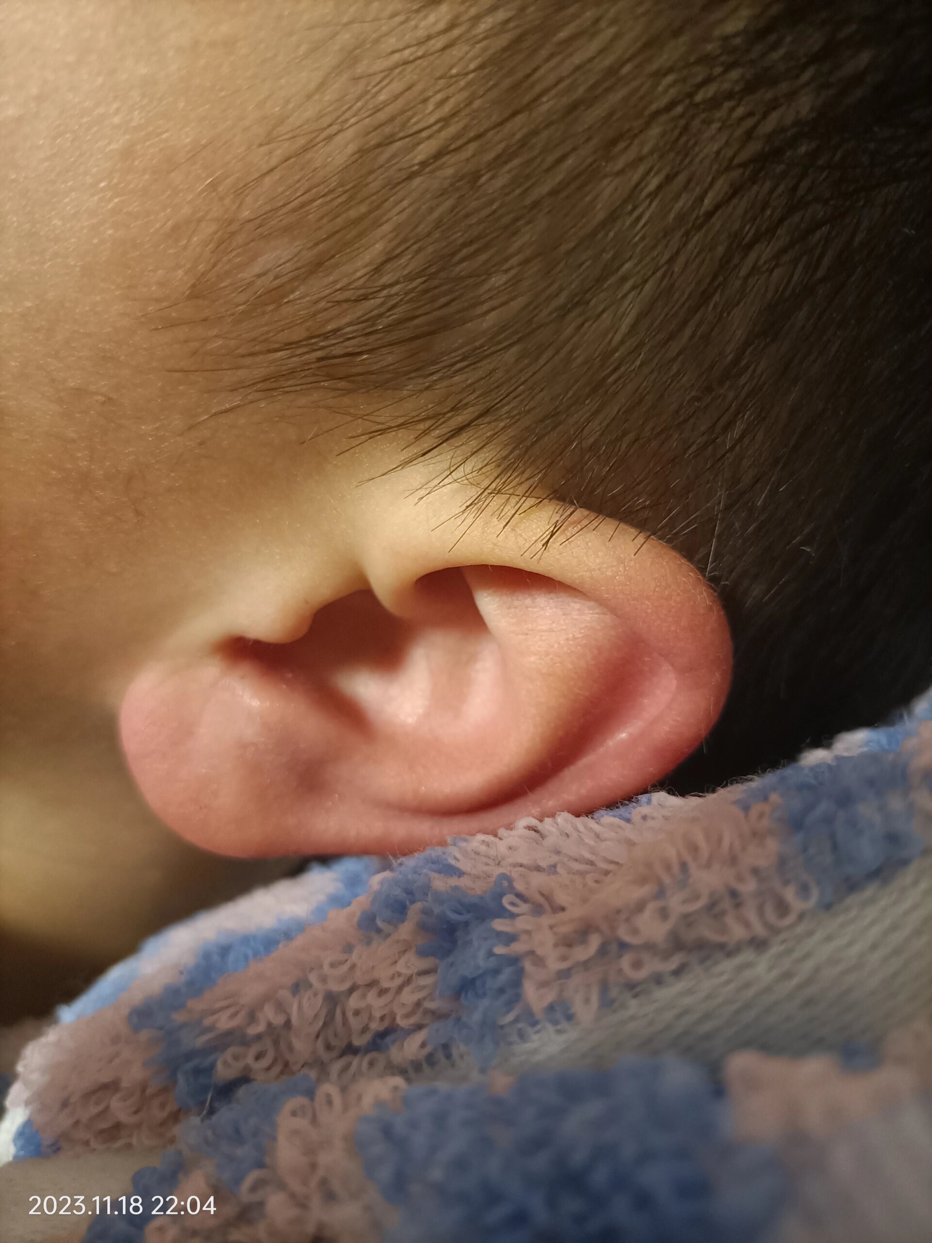 孩子一到晚上就耳朵发红发烫