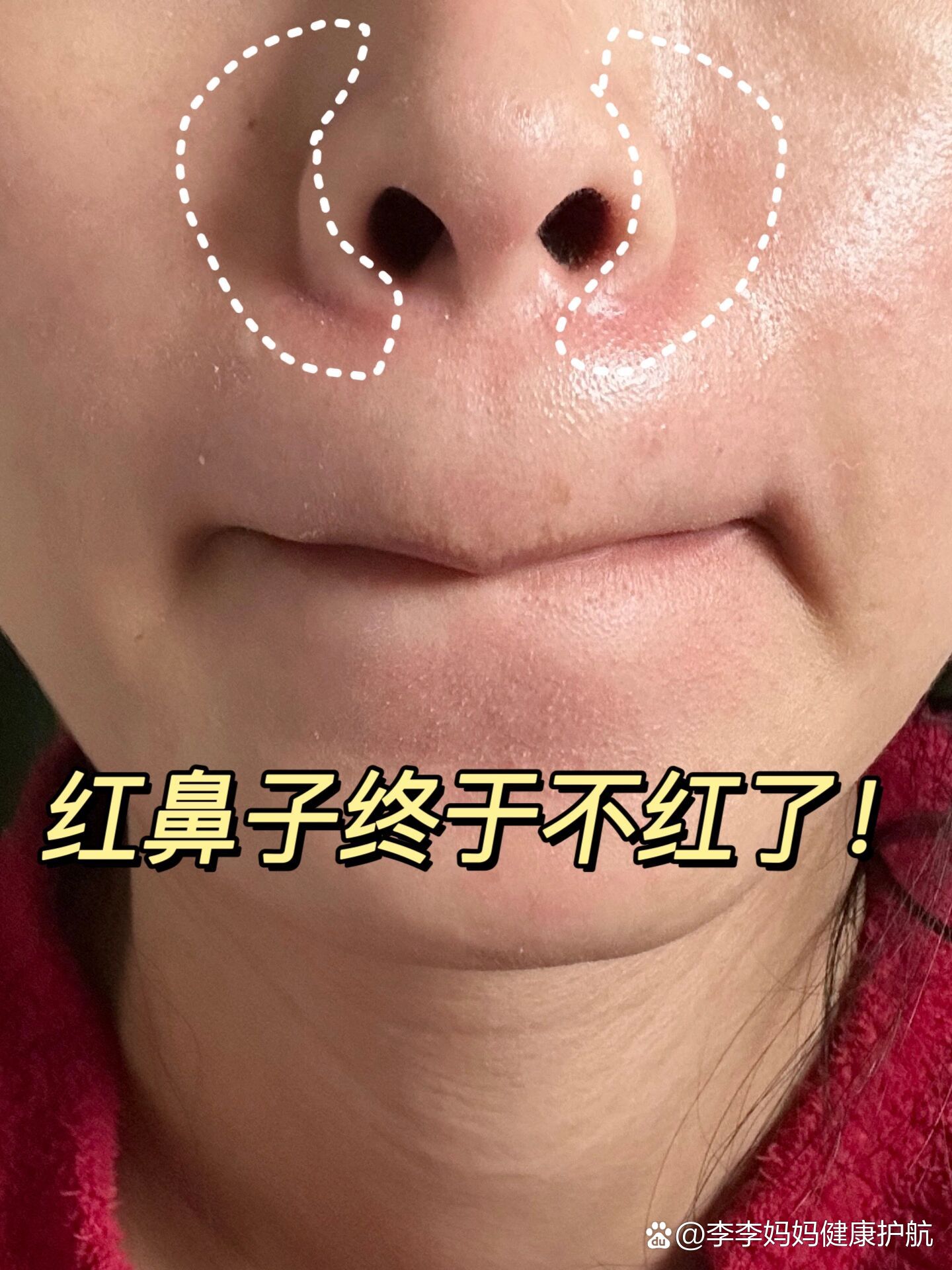 皮肤变得格外敏感,鼻子两侧总是红烫的还爆皮!