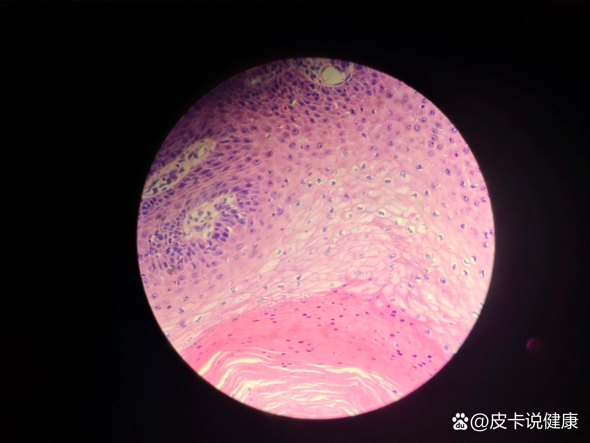 皮肤乳头状瘤