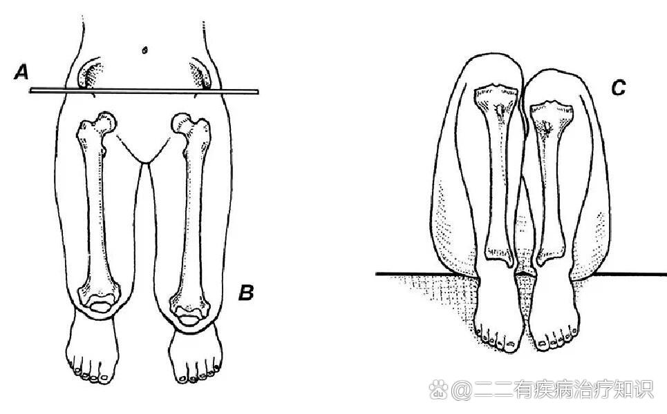 长短腿的伙伴们看过来,关于长短腿的危害7215
