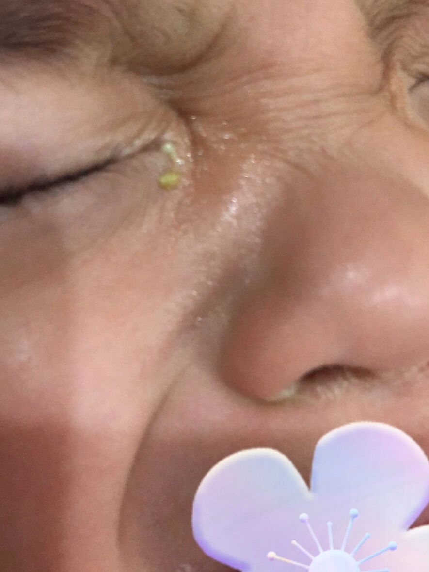 但是后面眼屎分泌很多.而且颜色也不正常. 观察了两天.