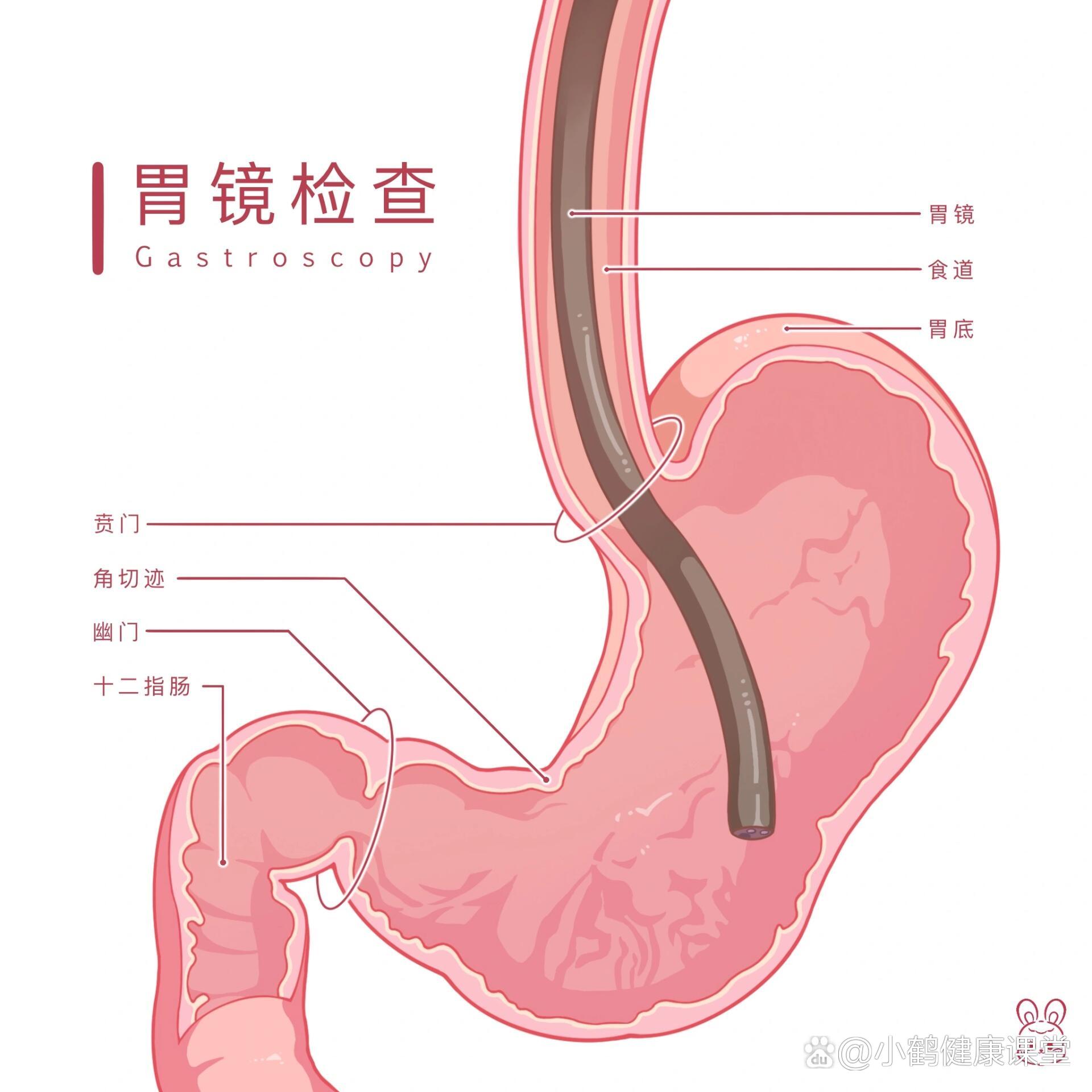 p 胃镜能看些什么咧 br 胃镜下所见包括 食管 贲门 胃底 胃体 胃角