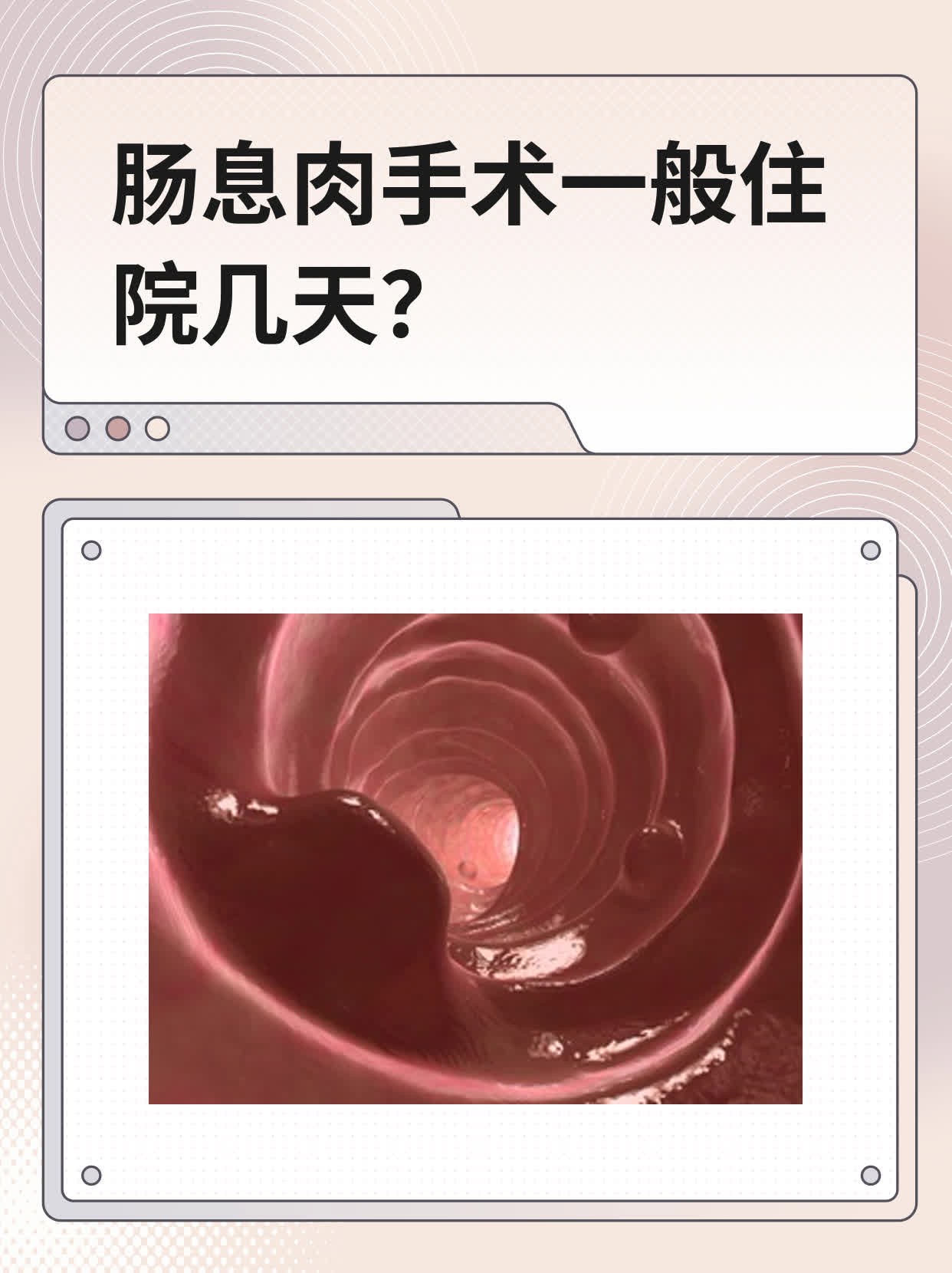 肠息肉手术一般住院几天