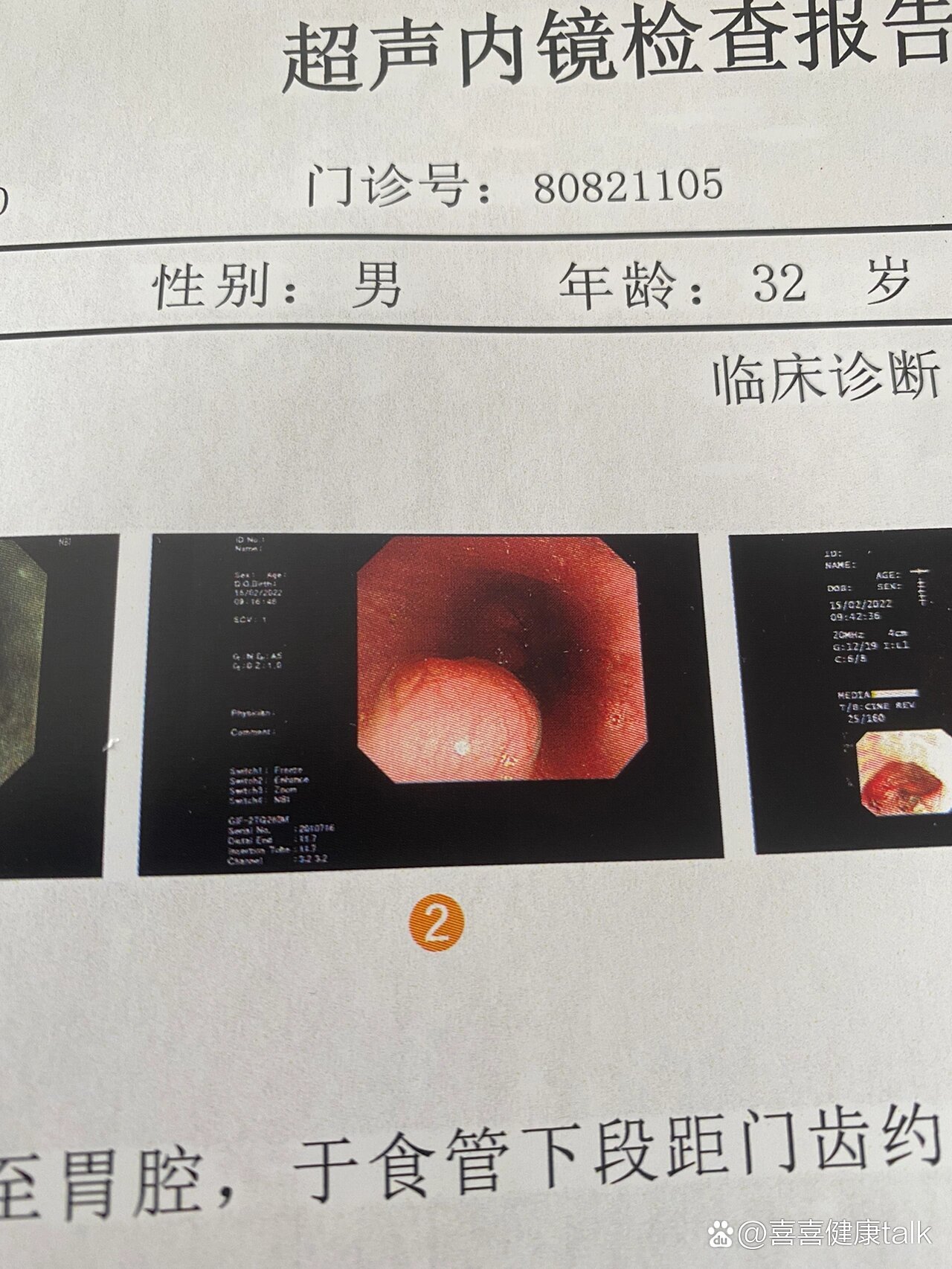 食管平滑肌瘤二月份想做个胃镜就去看了,结果查出来个瘤