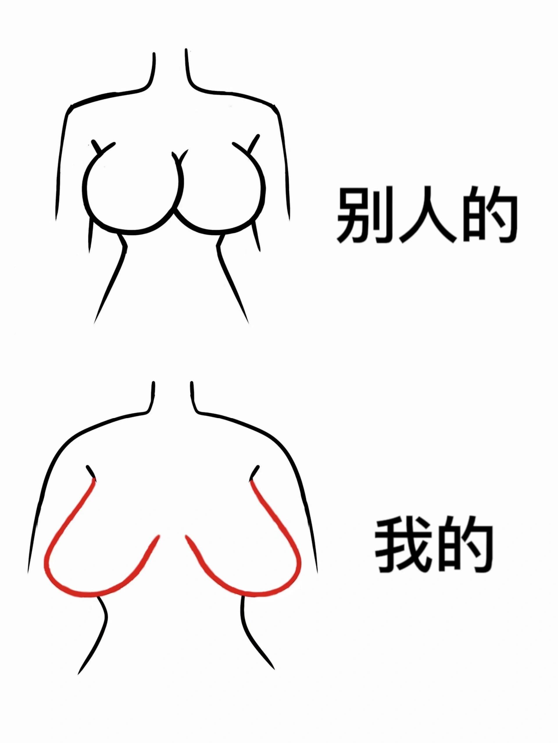20岁胸下垂成这样正常吗?