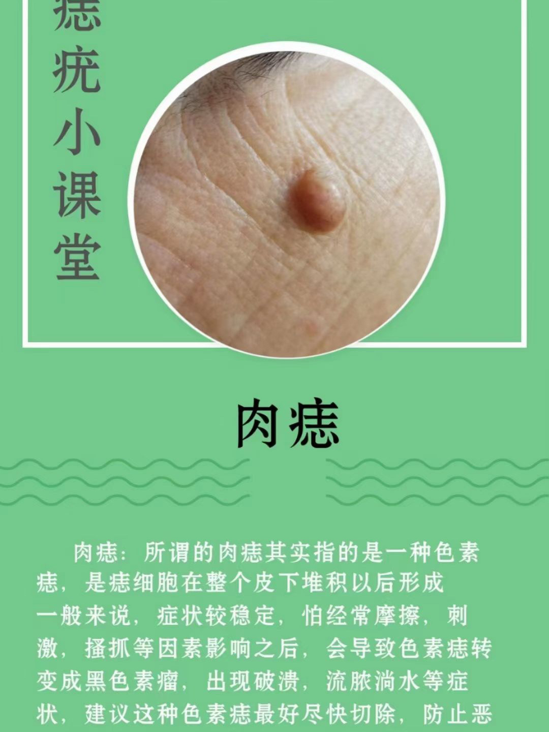 科普…肉痣!