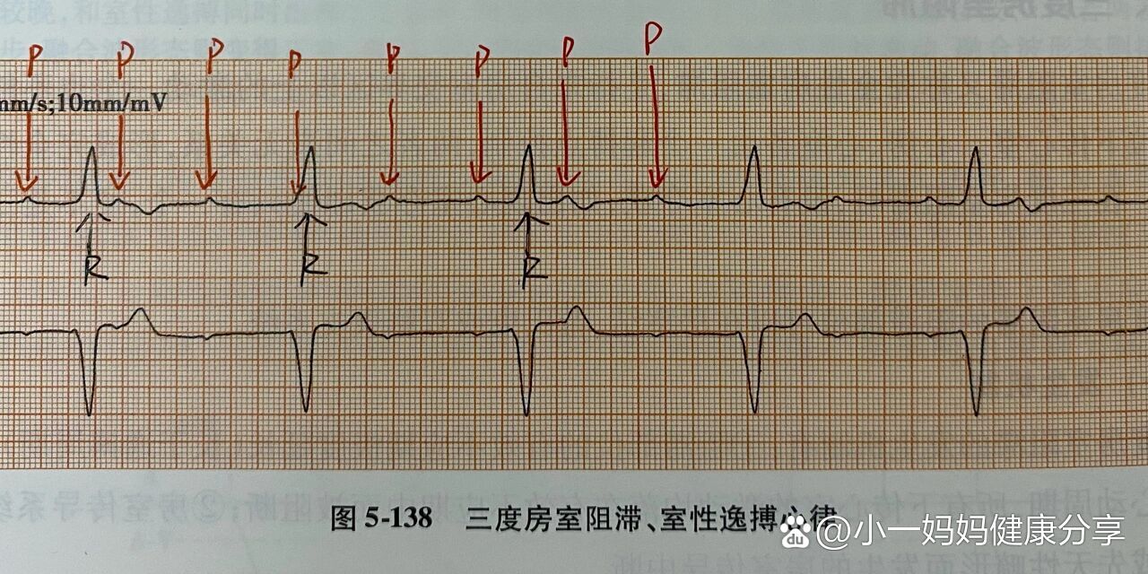 心房心室图简易图片