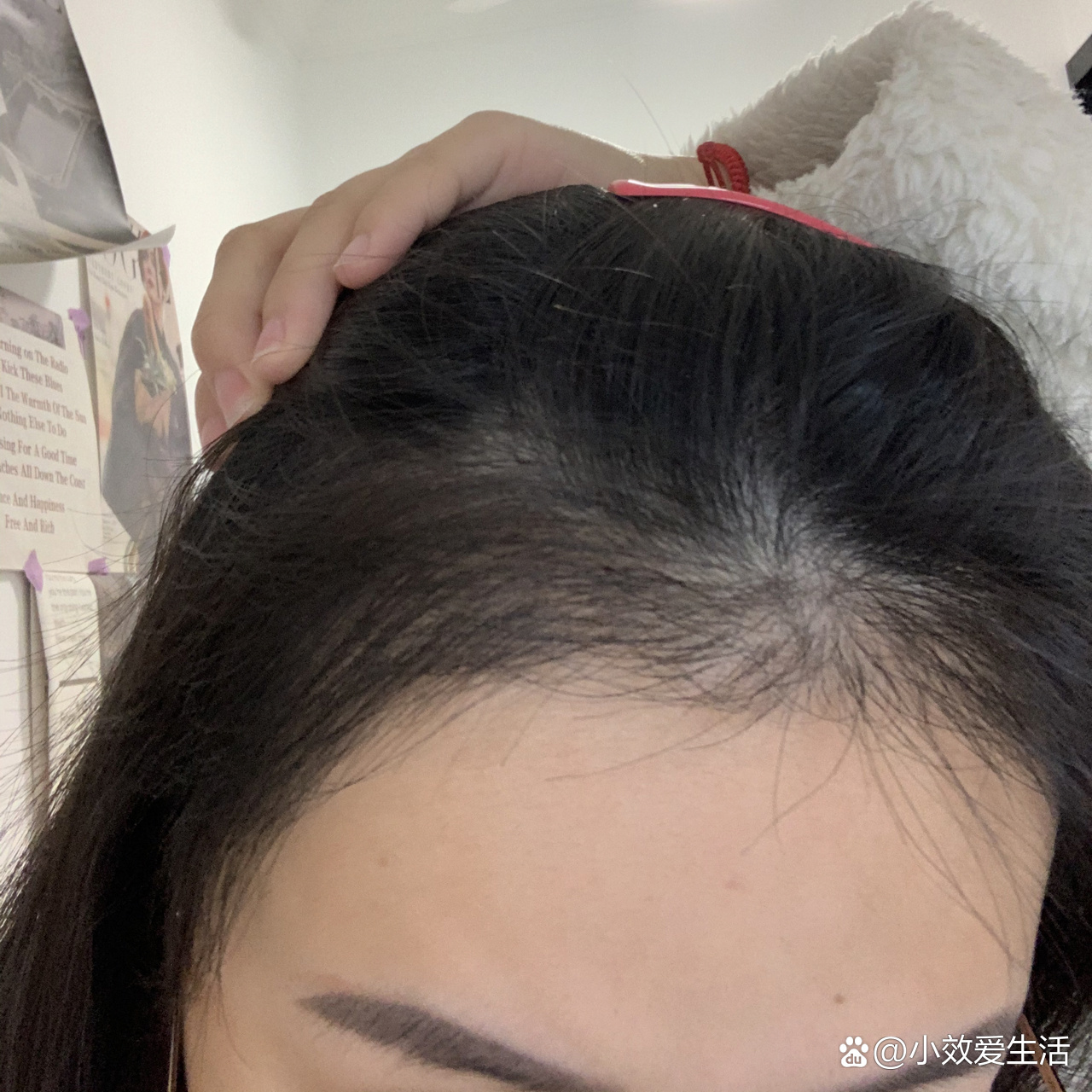 休止期植发(植发休眠期有多久)