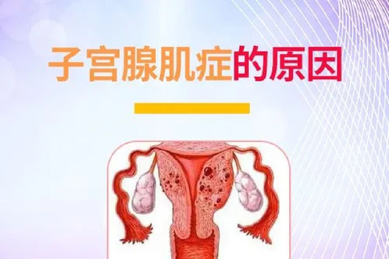 以下五种原因导致患上子宫腺肌症