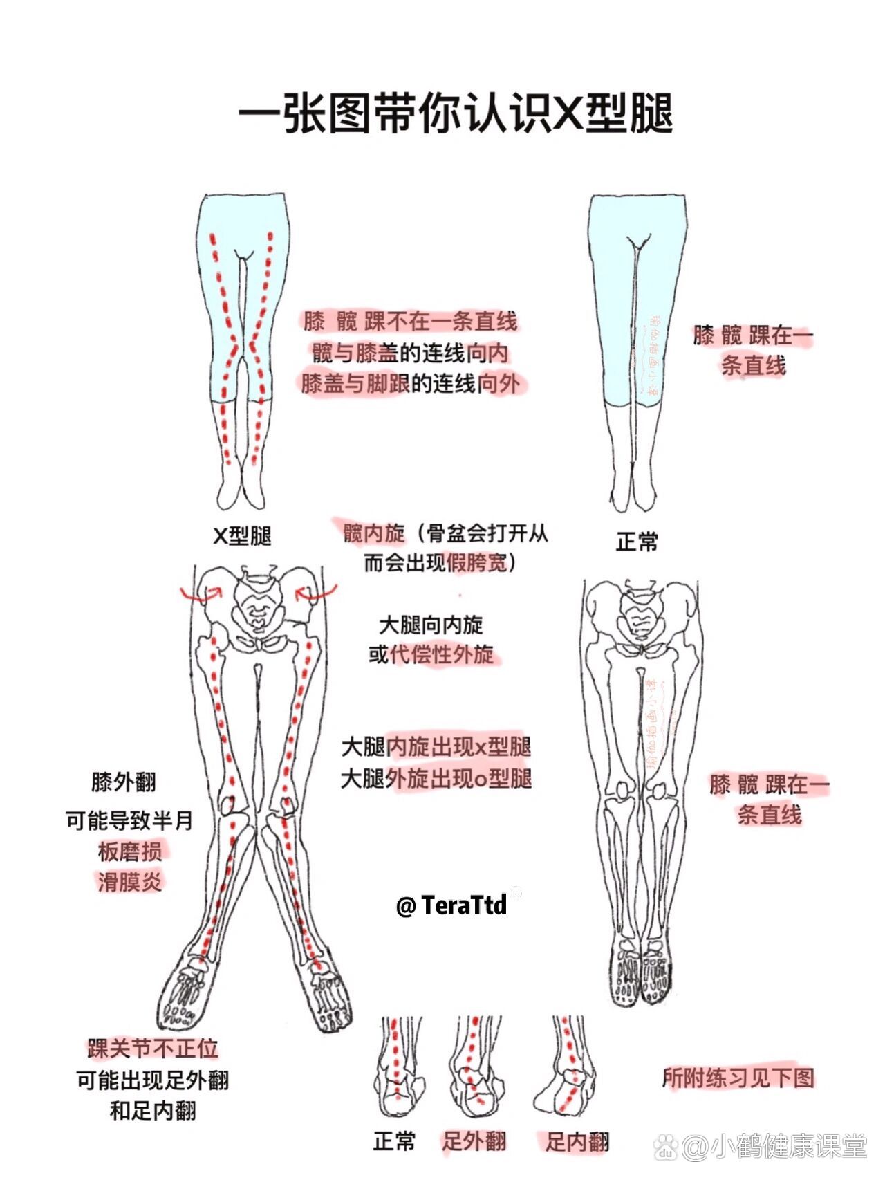 一张图带你认识x型腿