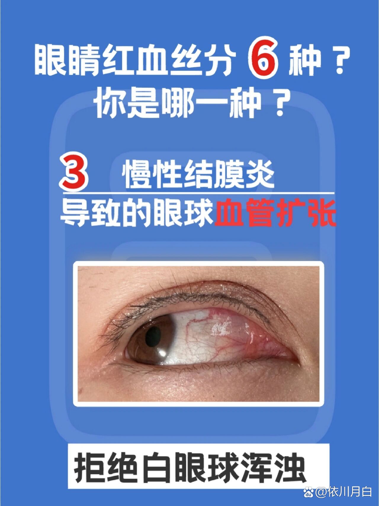 慢性结膜炎红血丝71白眼球发红的元凶75