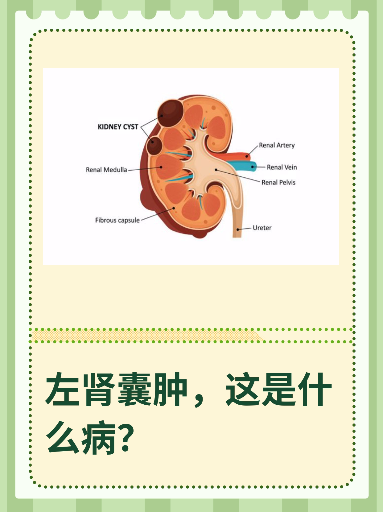左肾囊肿 全网资源