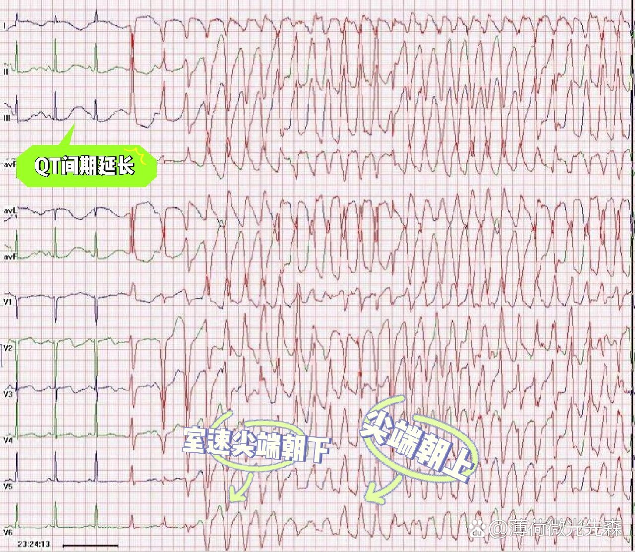 室性尖端扭转心电图图片