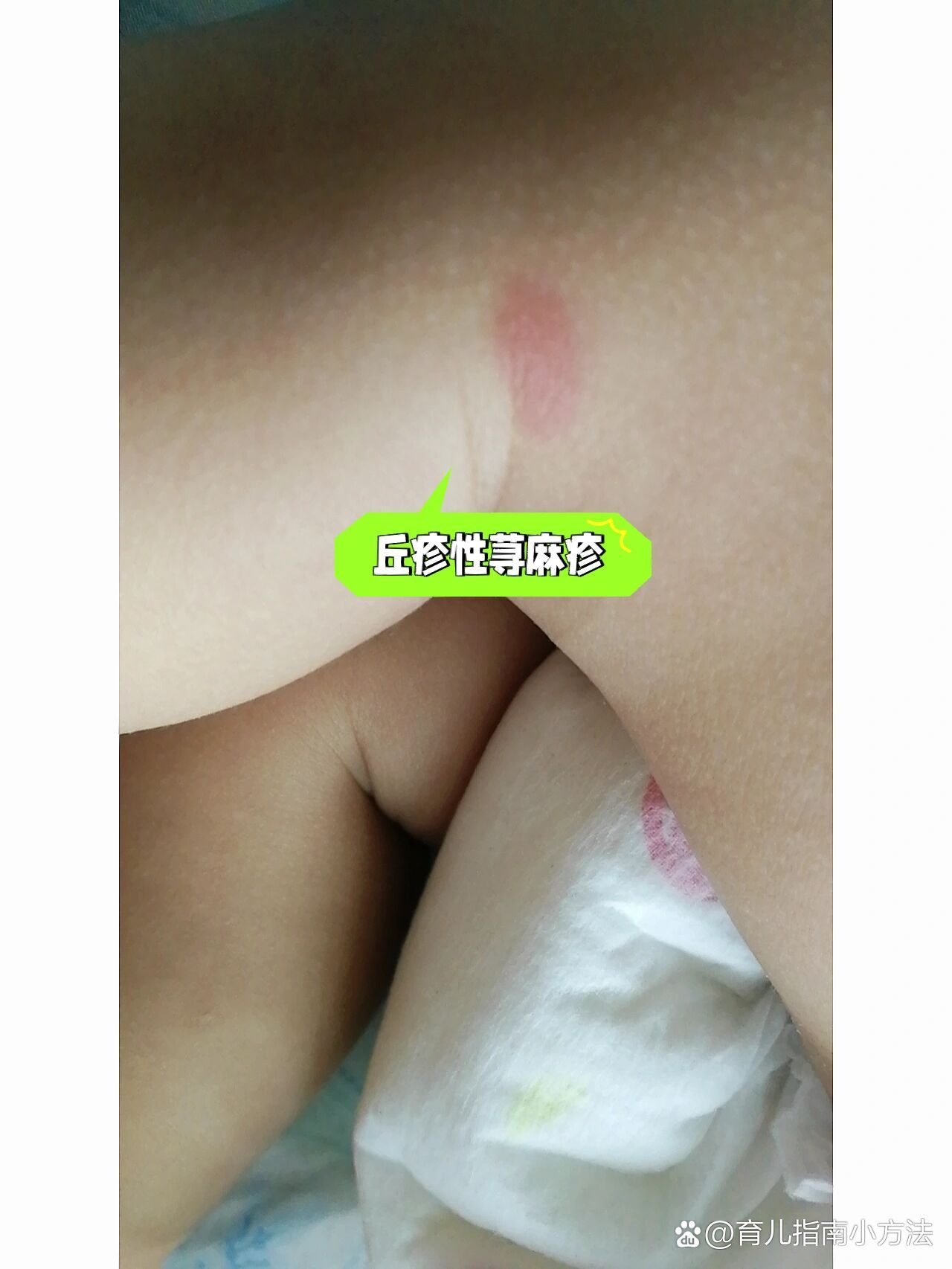 宝宝被虫子叮咬过敏长丘疹性荨麻疹!