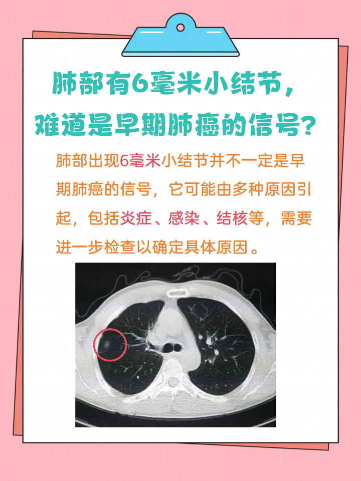 肺部有6毫米小结节,难道是早期肺癌的信号?