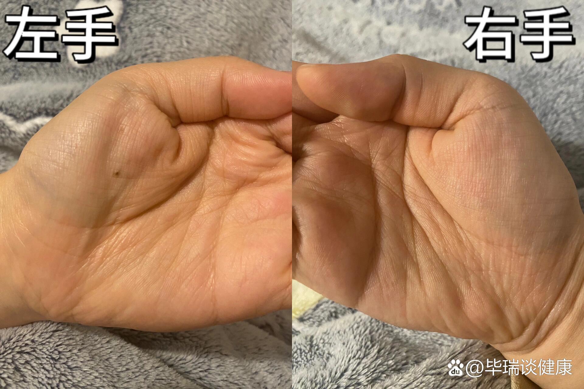 没有肌肉跳动可以排除渐冻症吗