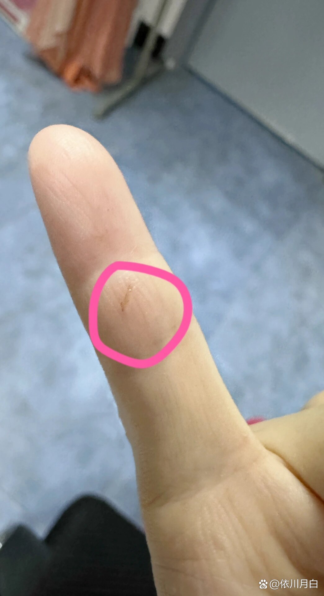 被刮破这一点点需要打破伤风针吗