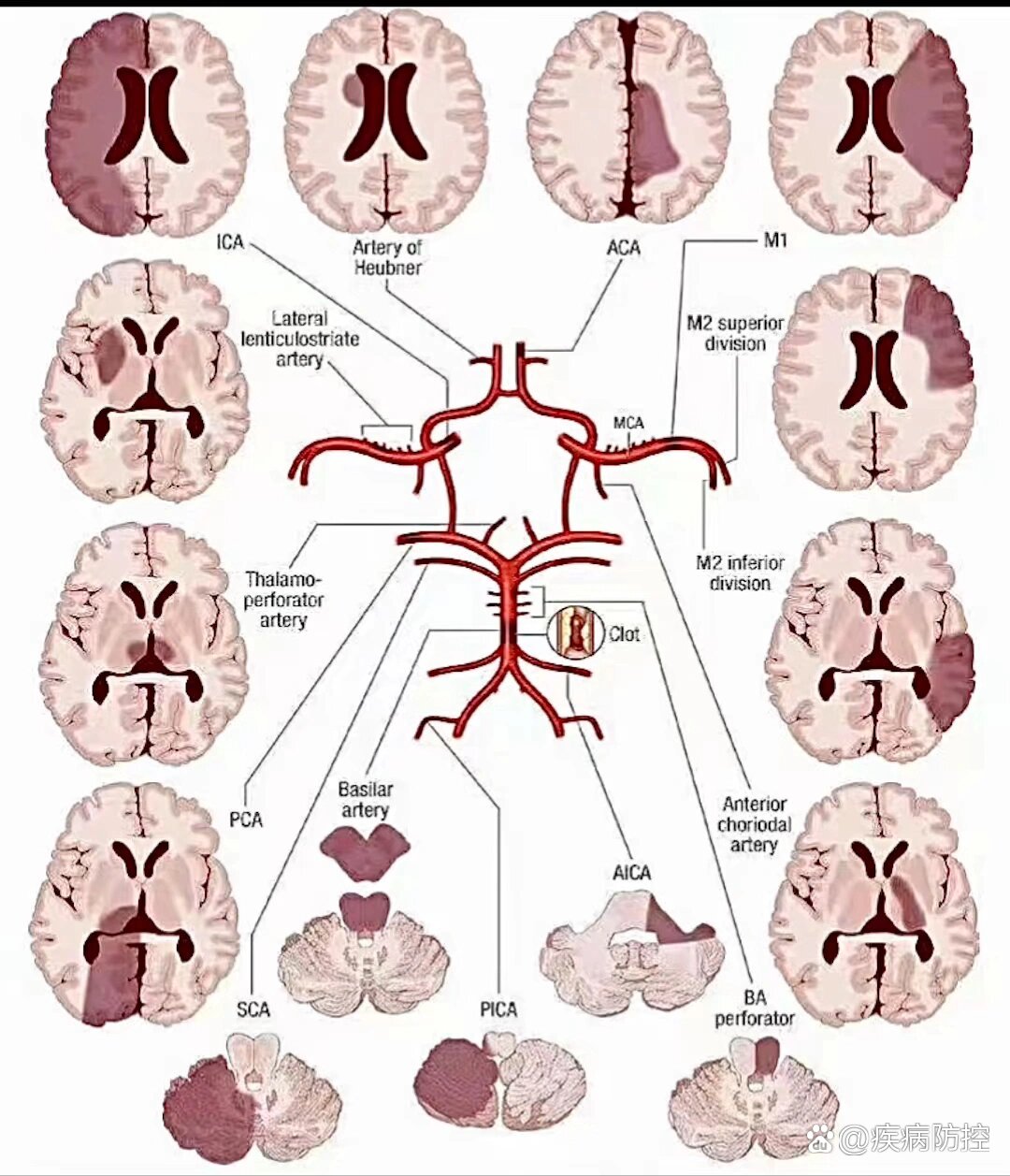一张图记住脑动脉供血区梗塞