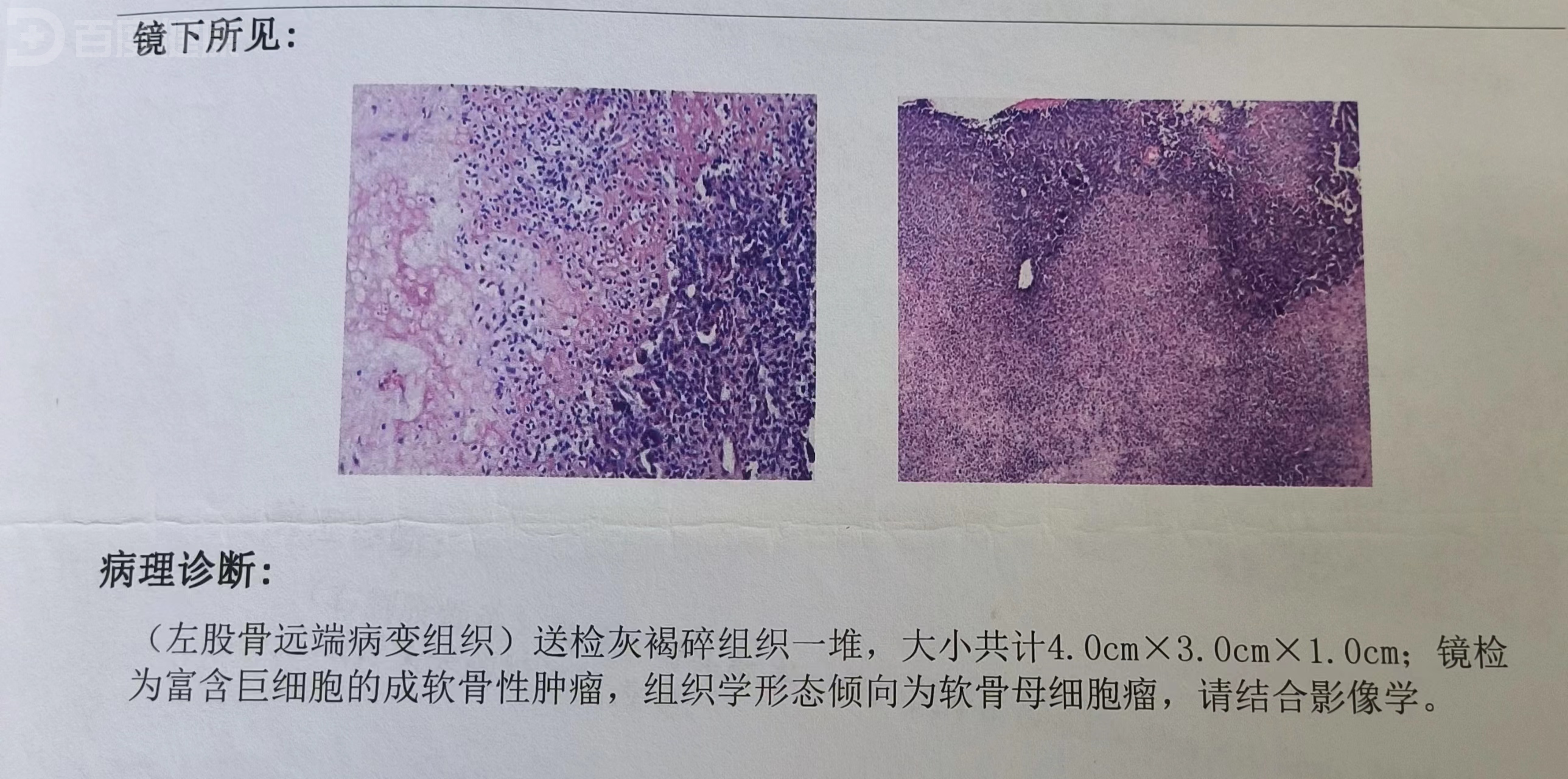 软骨母细胞瘤的手术治疗