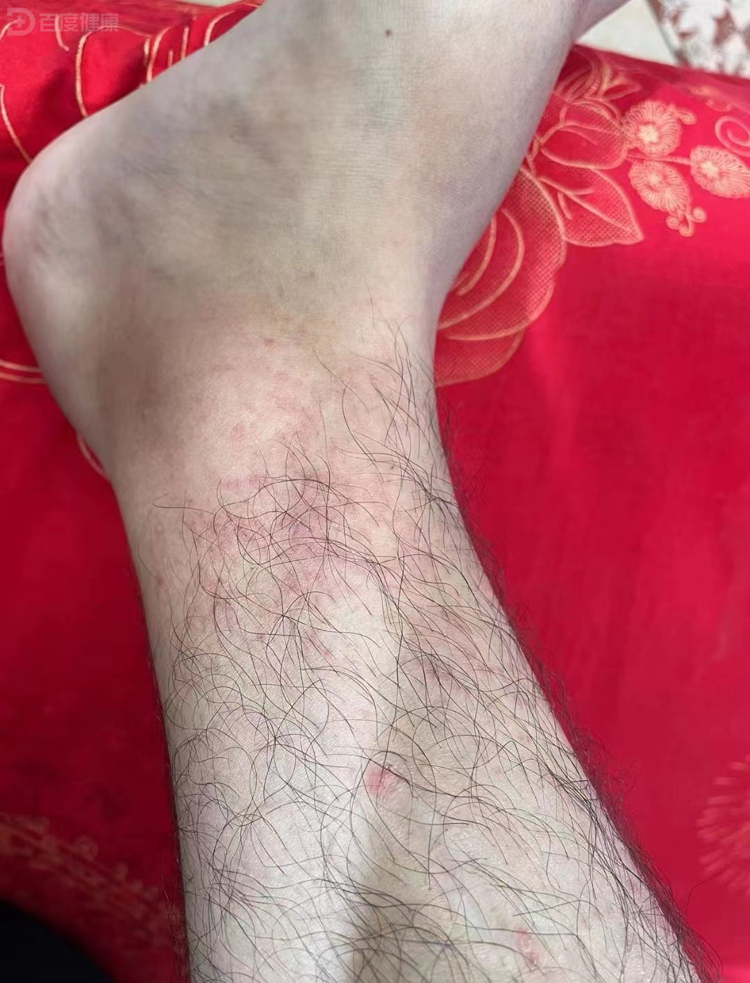 学生腿部出现红斑,原来是小腿皮炎在作怪
