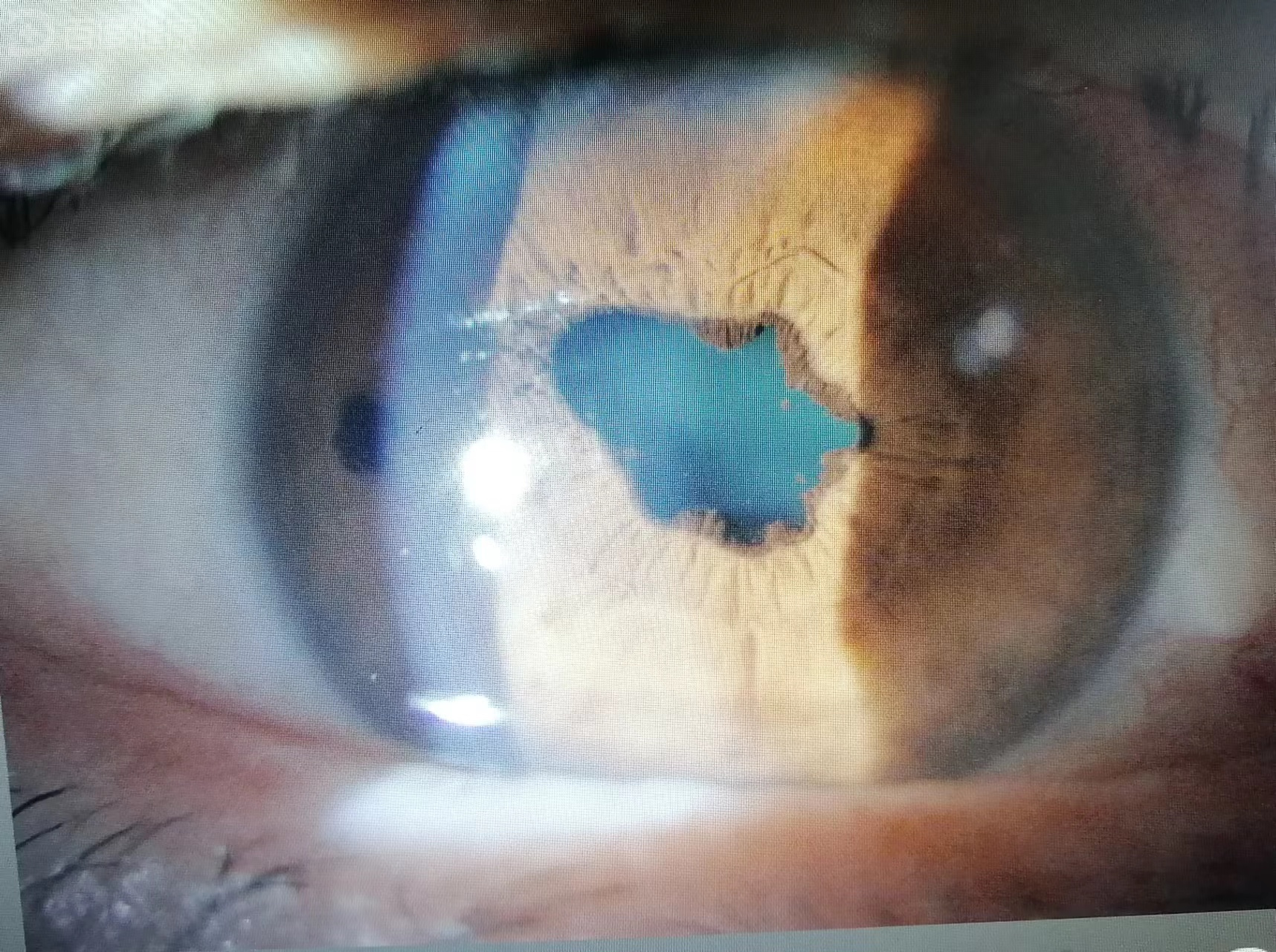 一例虹膜睫状体炎的治疗体会