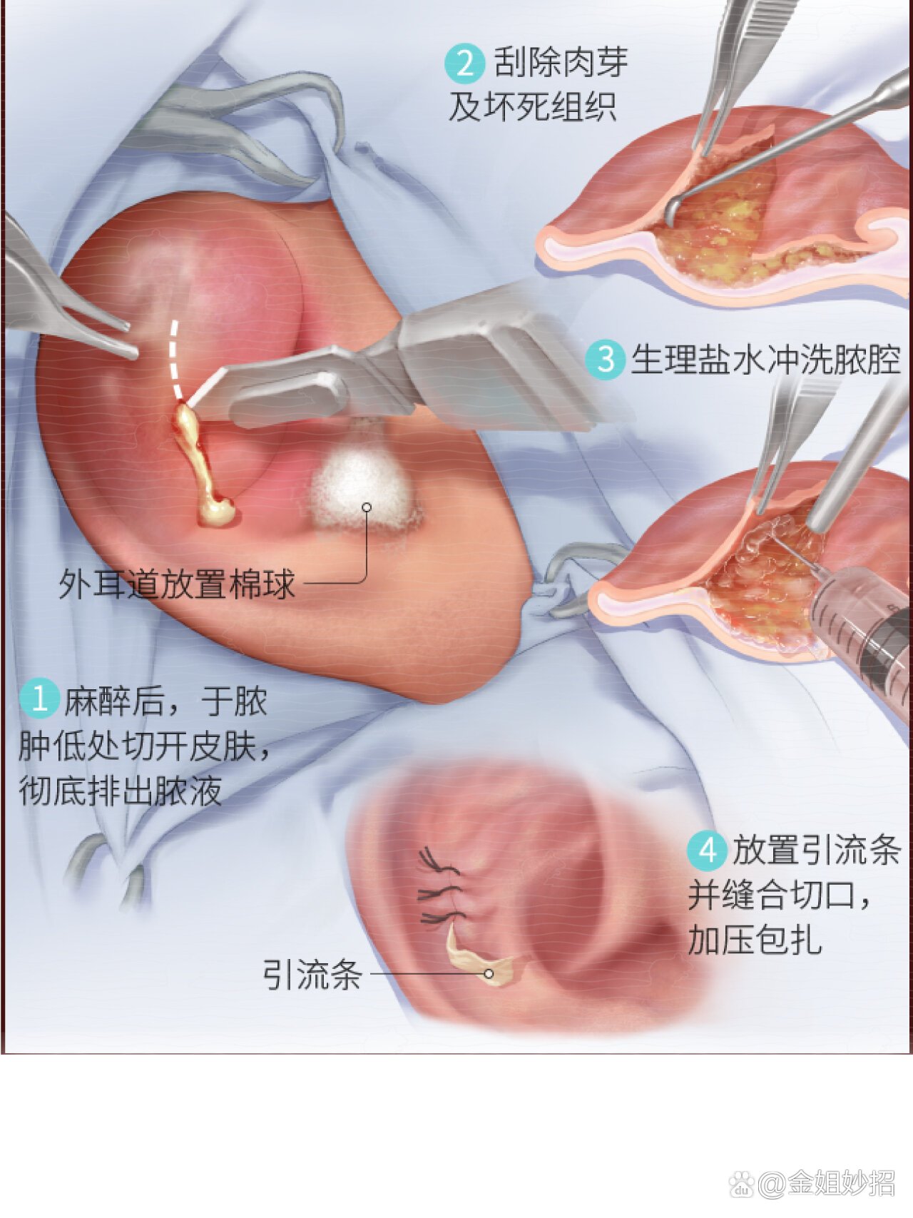 耳朵肉芽切除手术图解图片