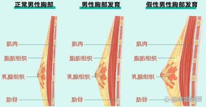 简单方法教你辨别男性乳腺发育