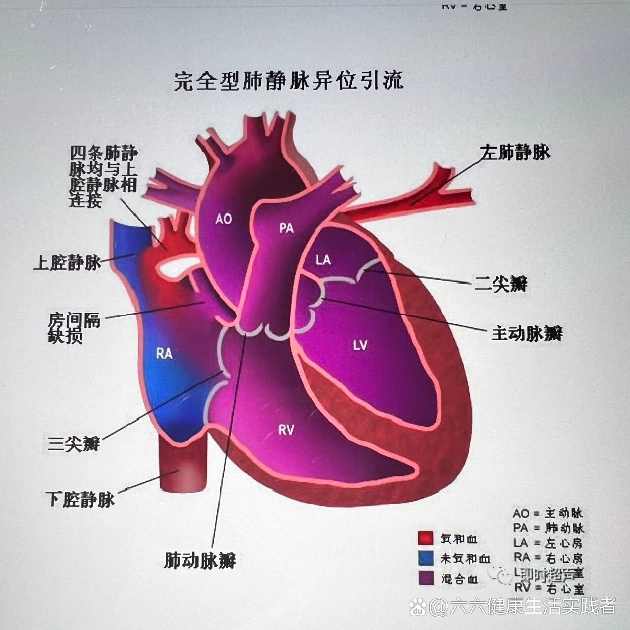 肺静脉异位引流图片