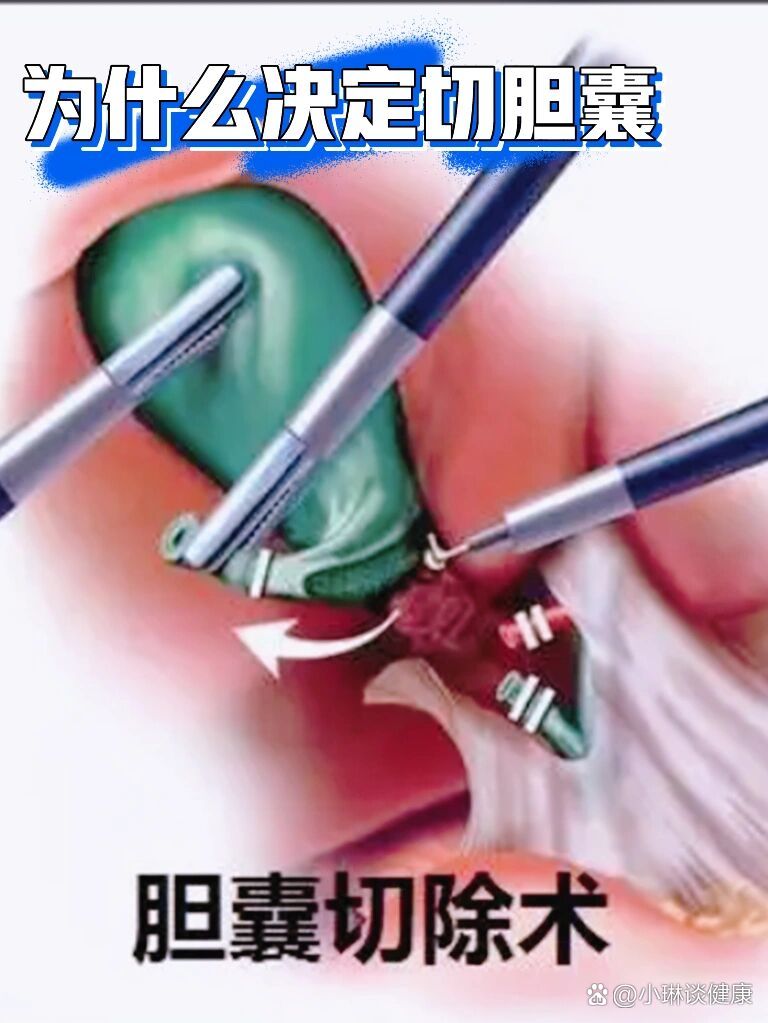 胆囊切除经历【一】——做切胆决定的过程