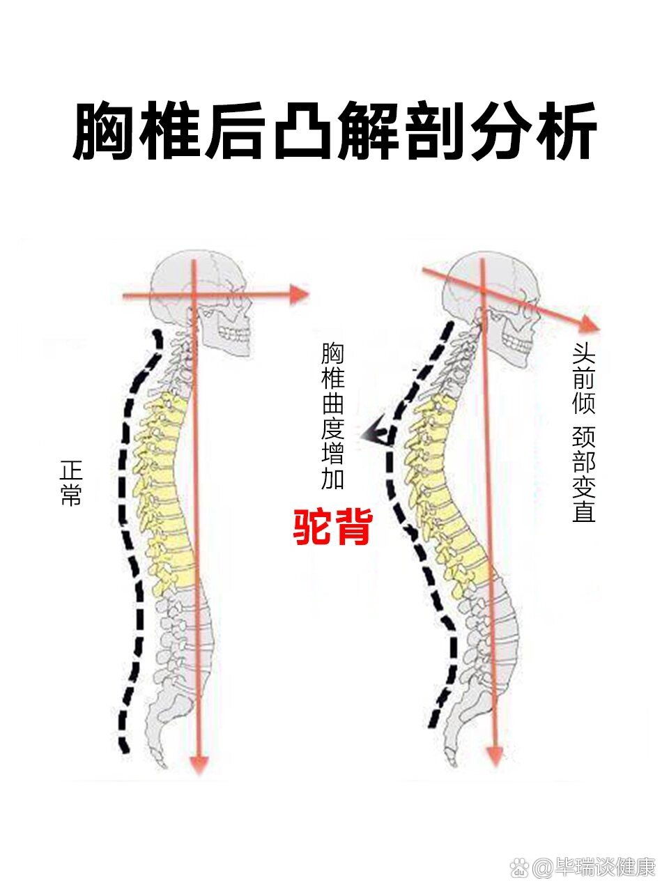 胸椎后凸正常范围图片