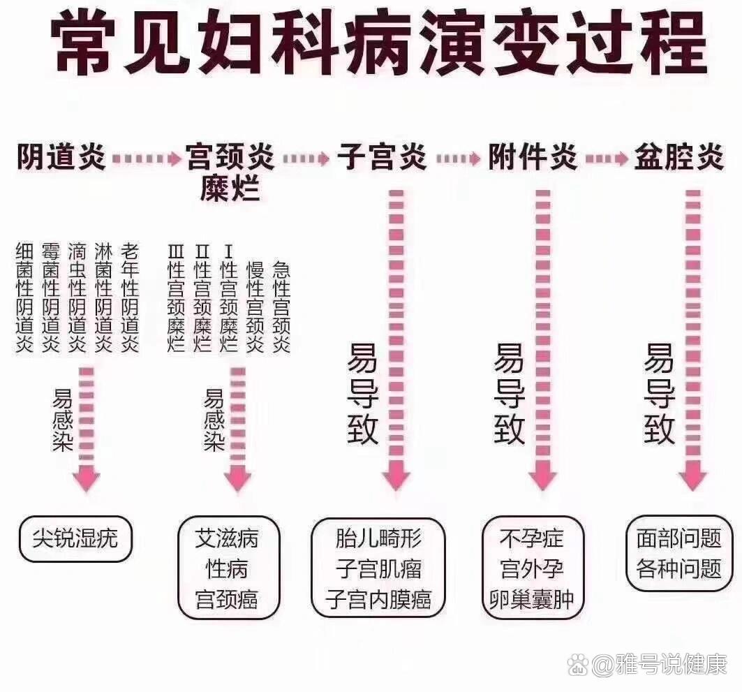 常见20种妇科病图片图片