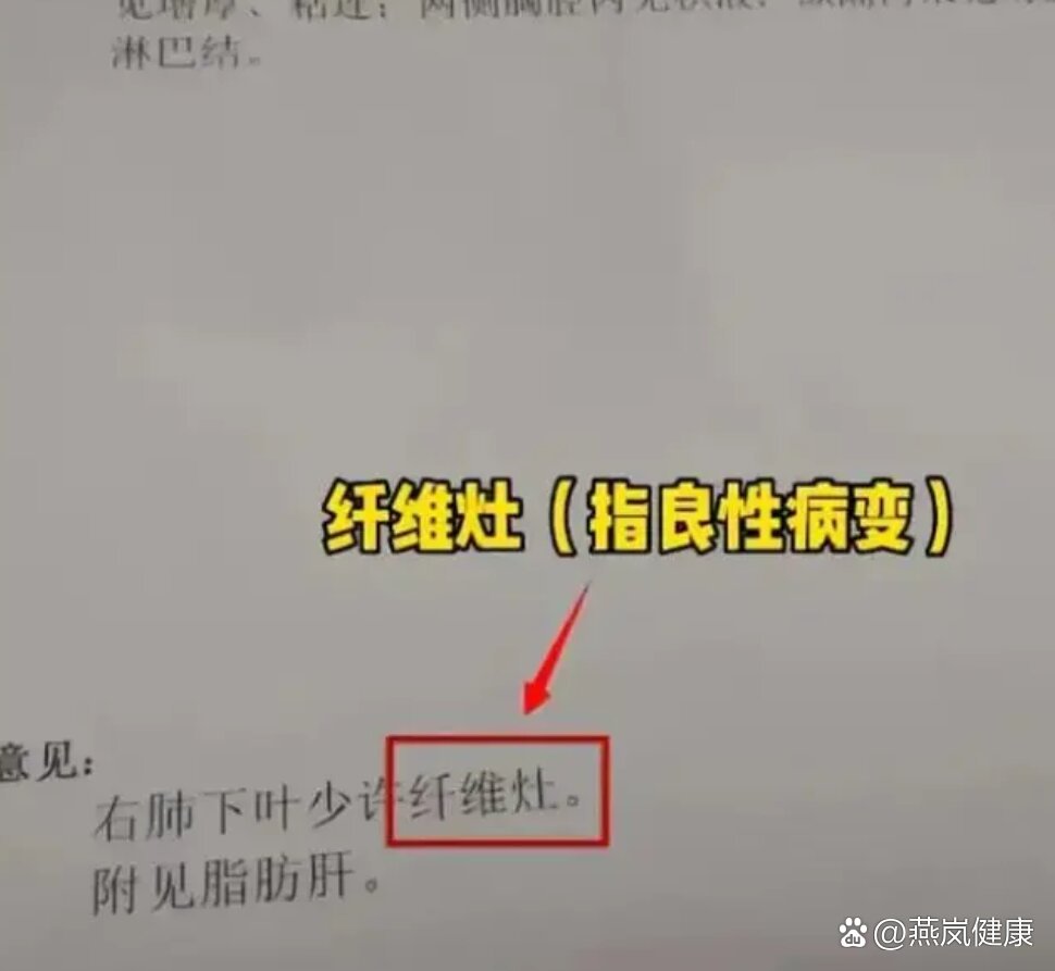 肺ct提示纤维灶