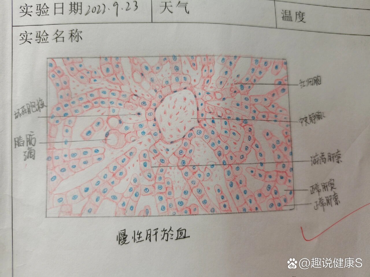 混合血栓手绘图图片