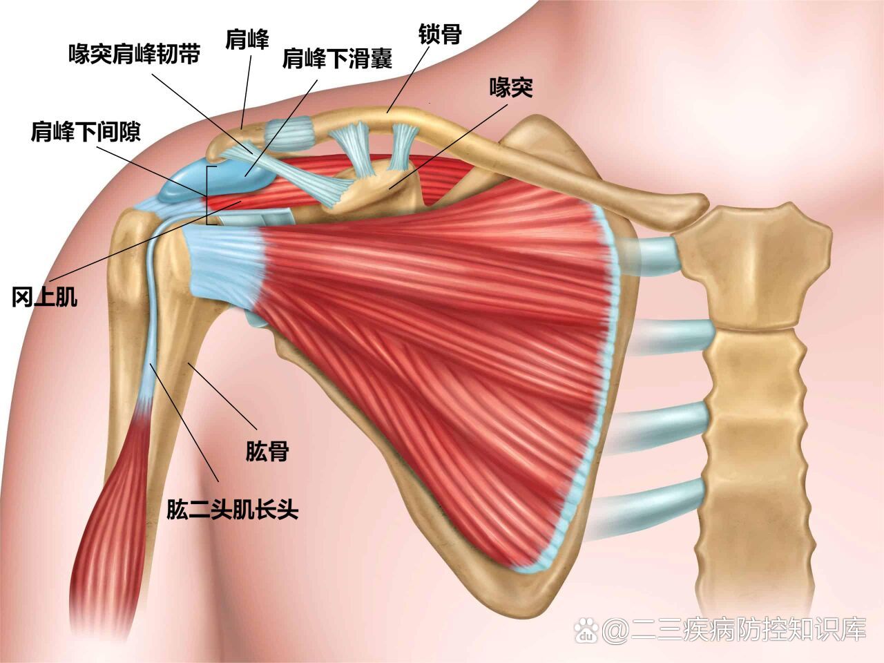 导致喙肩弓的炎症及肩峰的前1/3处的骨赘和增生