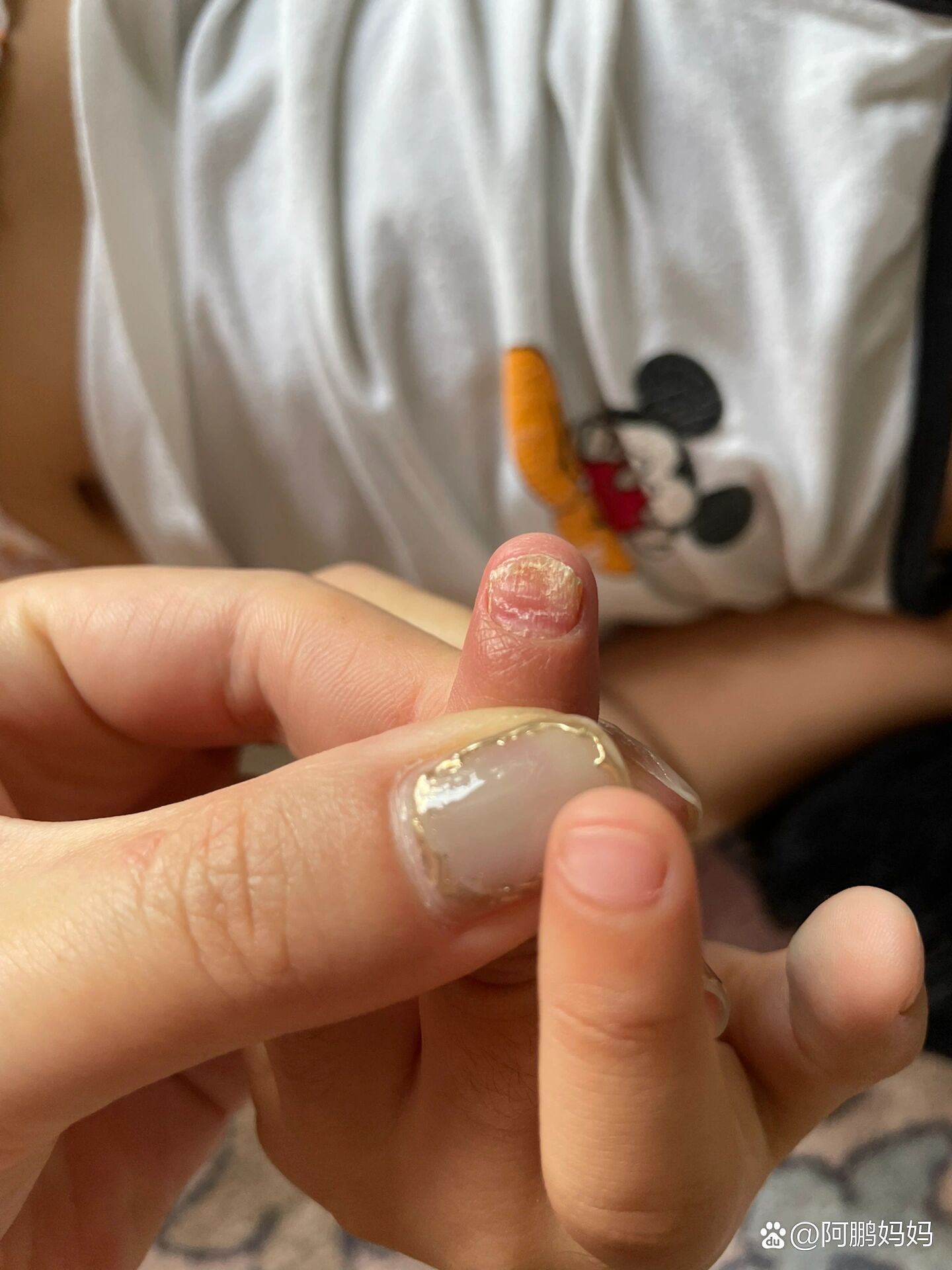 三岁宝宝手指甲