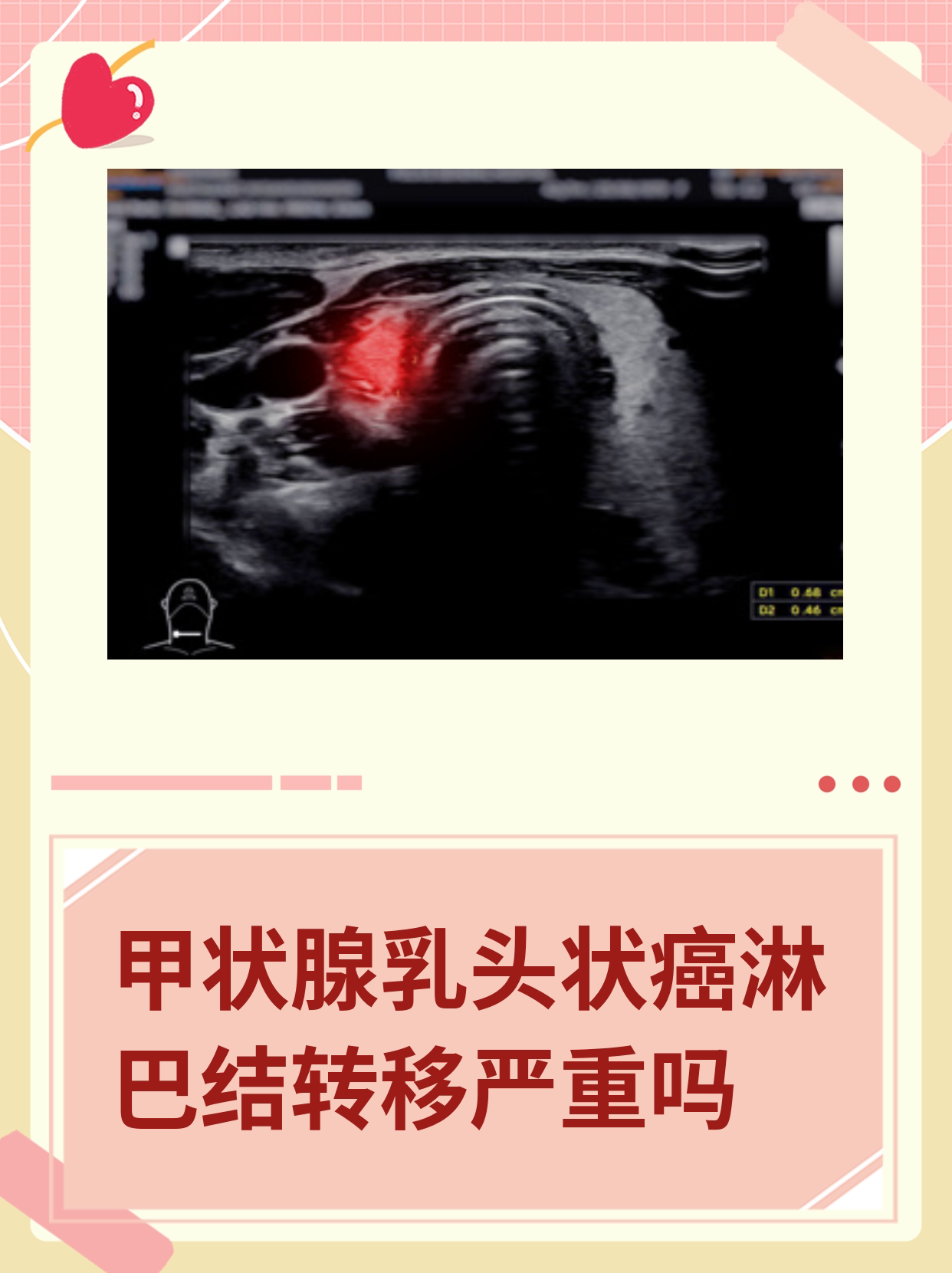 乳头状甲状腺癌图片