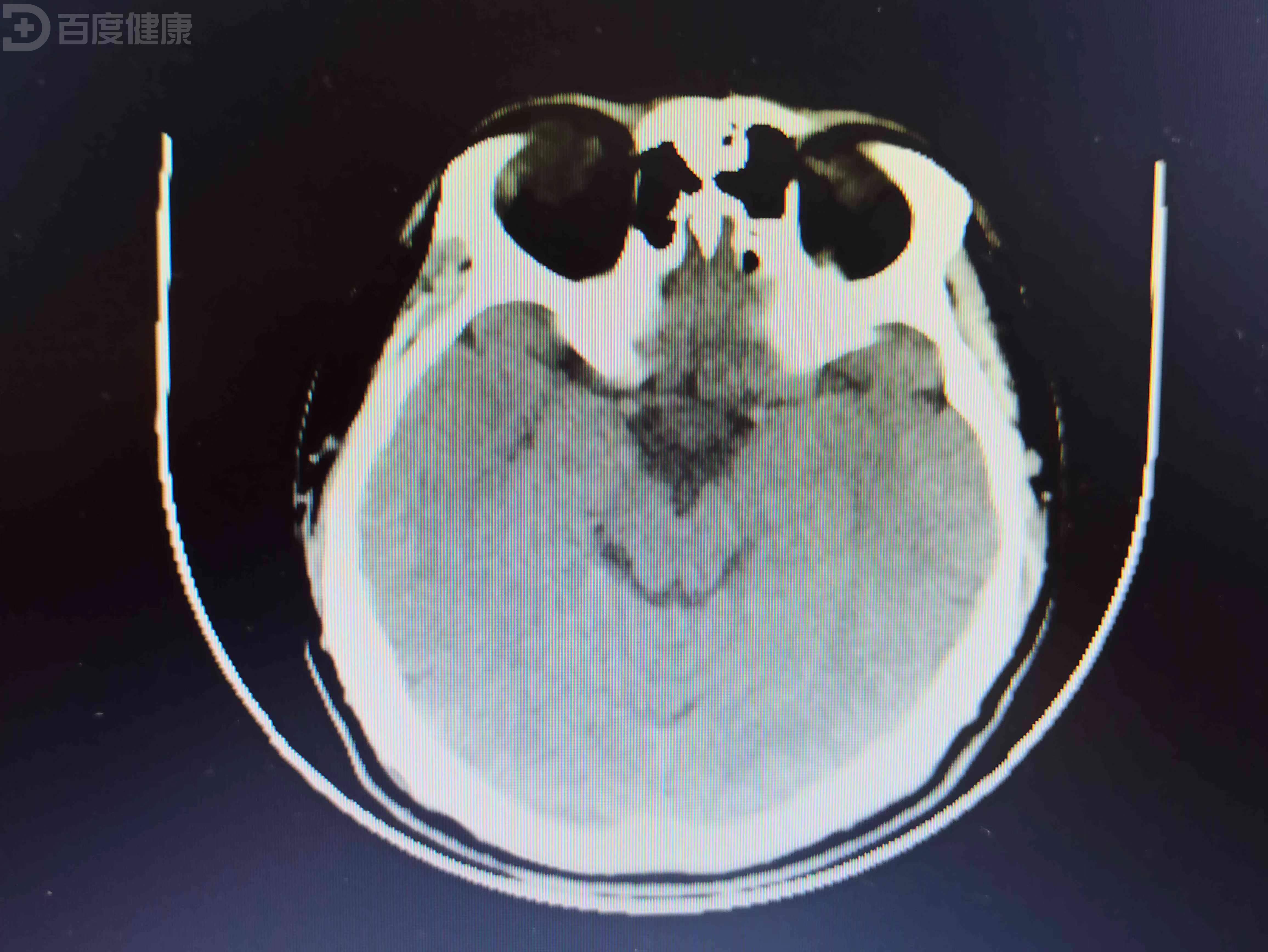 患者因跟人打架被打成脑震荡入院就诊