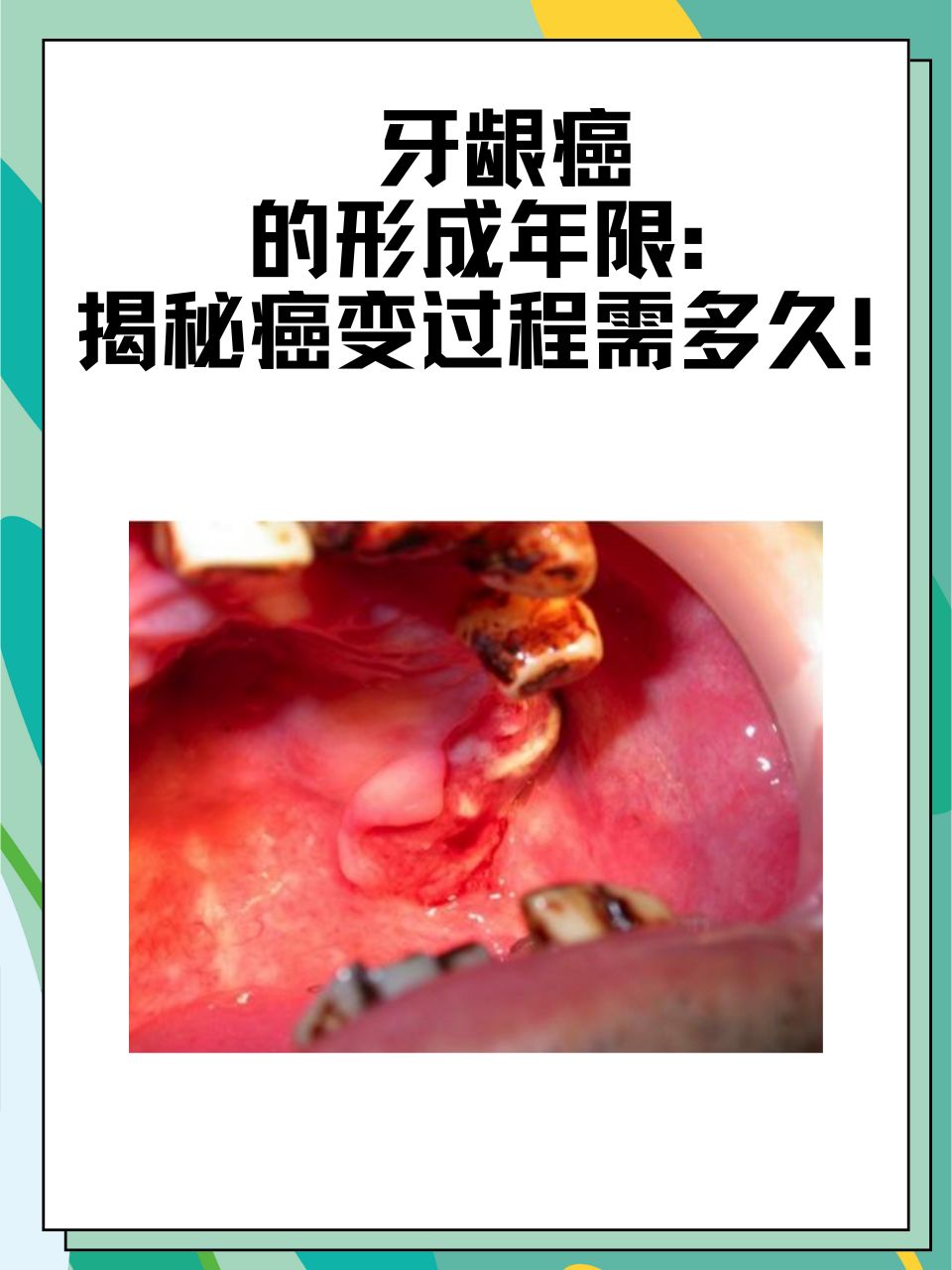 牙龈癌的形成年限:揭秘癌变过程需多久!